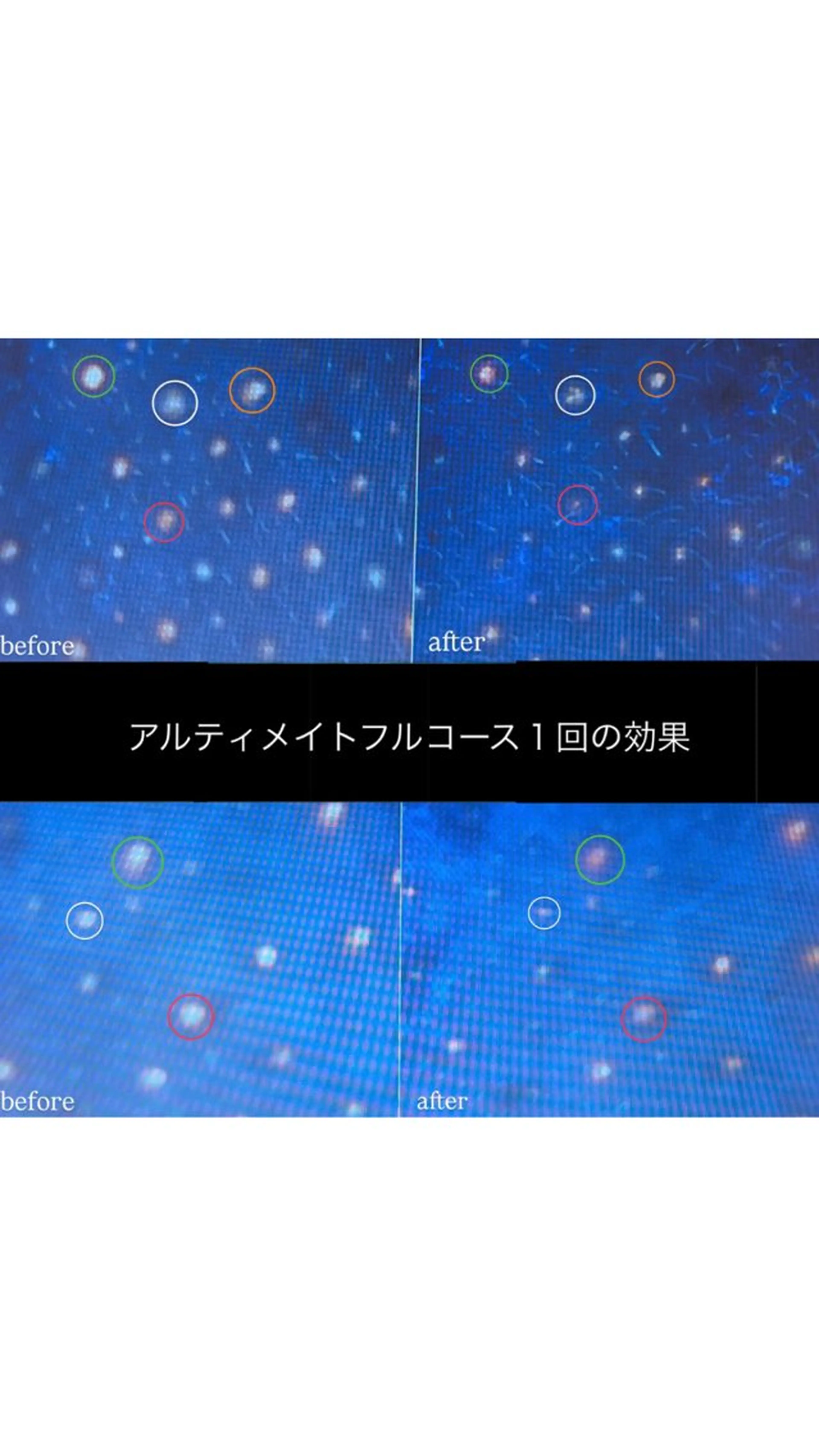 毛穴洗浄徹底コース🧹✨️  〈画像診断付き〉の写真