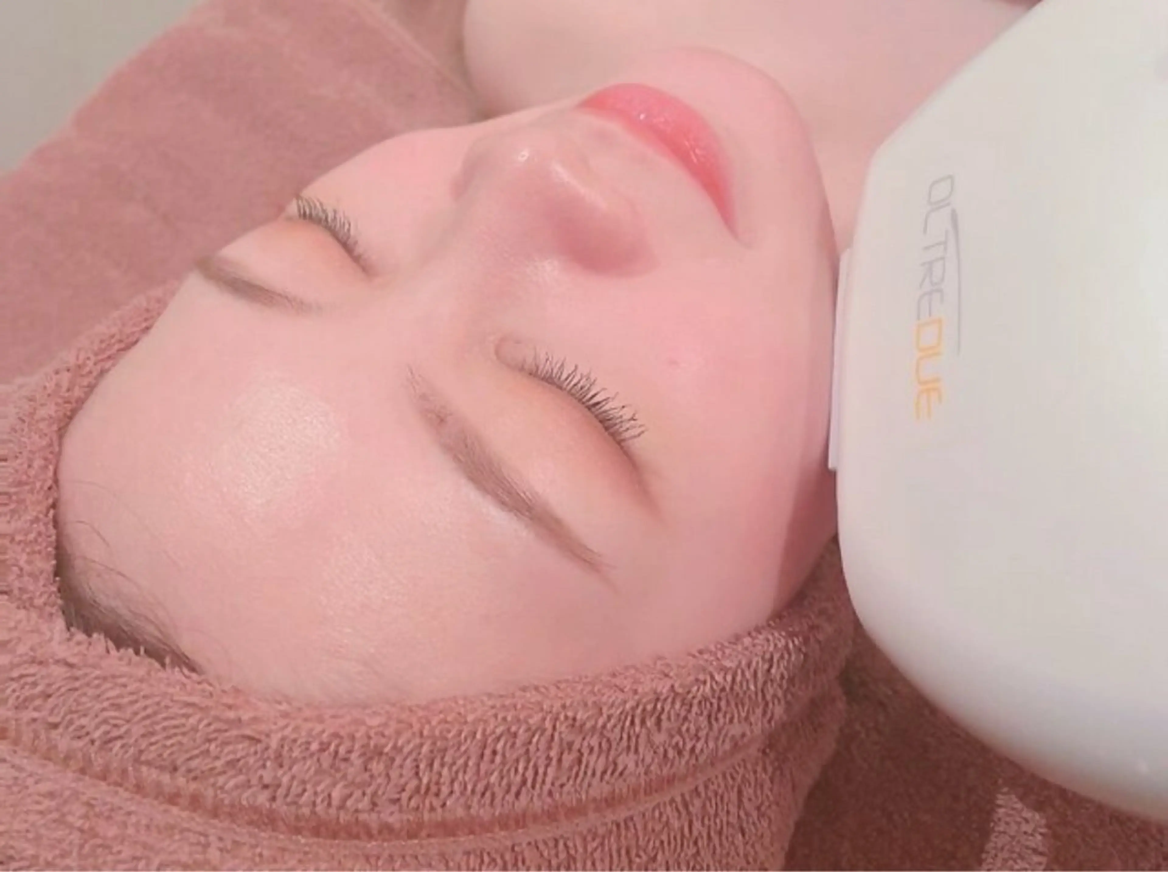 【顔脱毛】敏感肌の方にもおすすめ♪　顔まるごと脱毛＋角質除去つきの写真