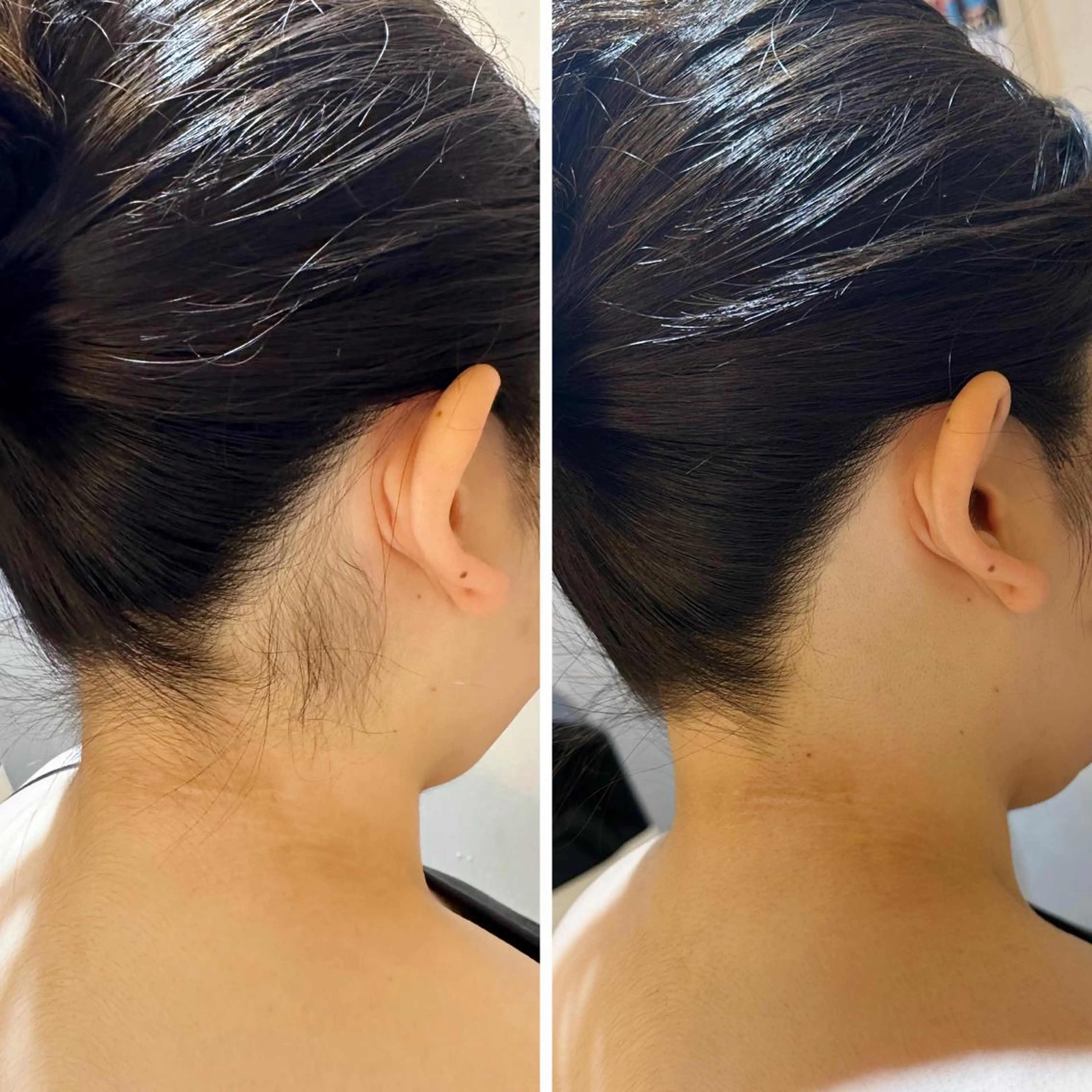 脱毛 うなじ脱毛/美肌脱毛 LABELのエステ・リラクイメージ