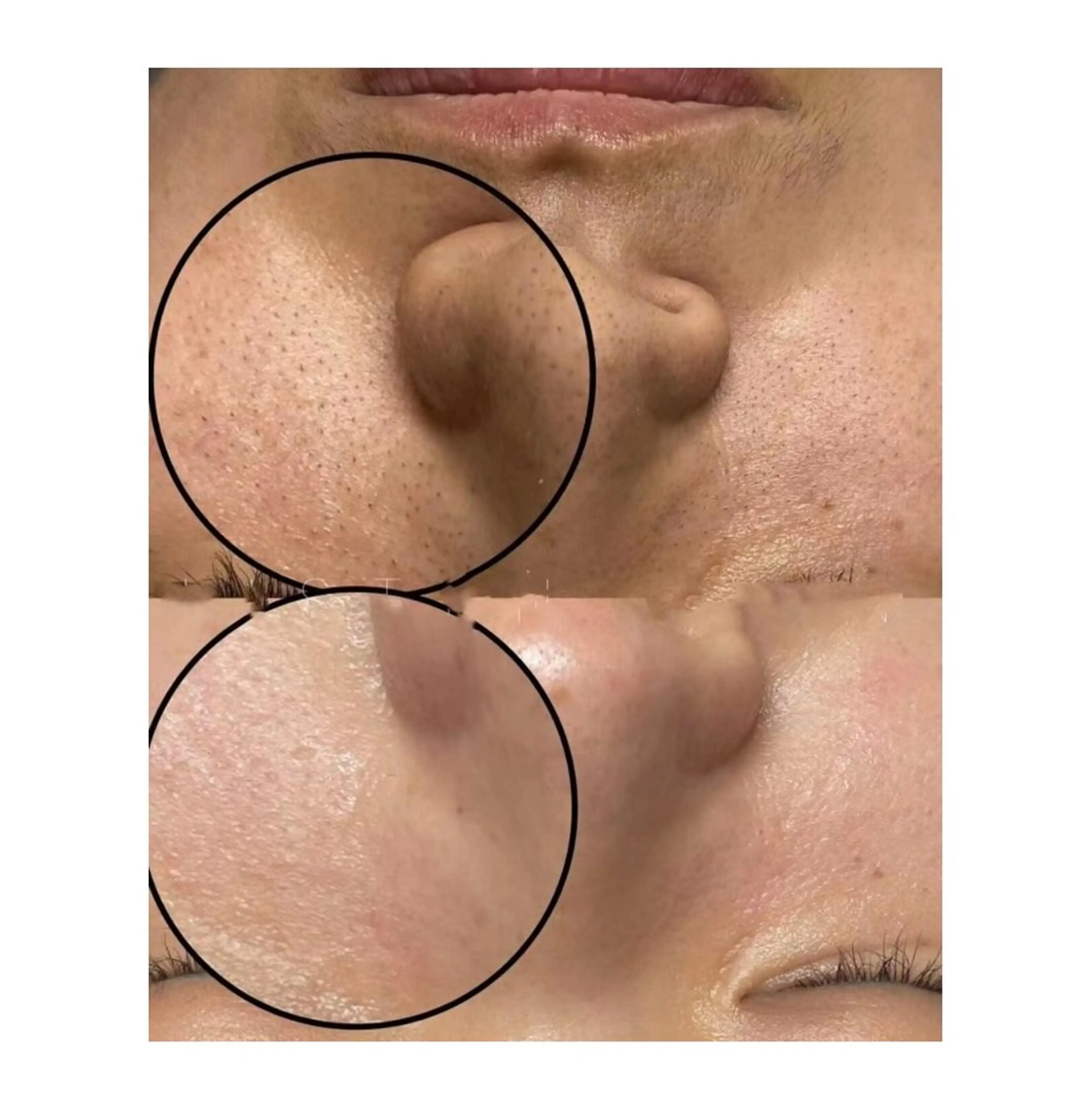 【毛穴洗浄！ハイドラフェイシャル】ビタミンC導入付き(デコルテ・フェイシャルマッサージ付)60分☁️の写真