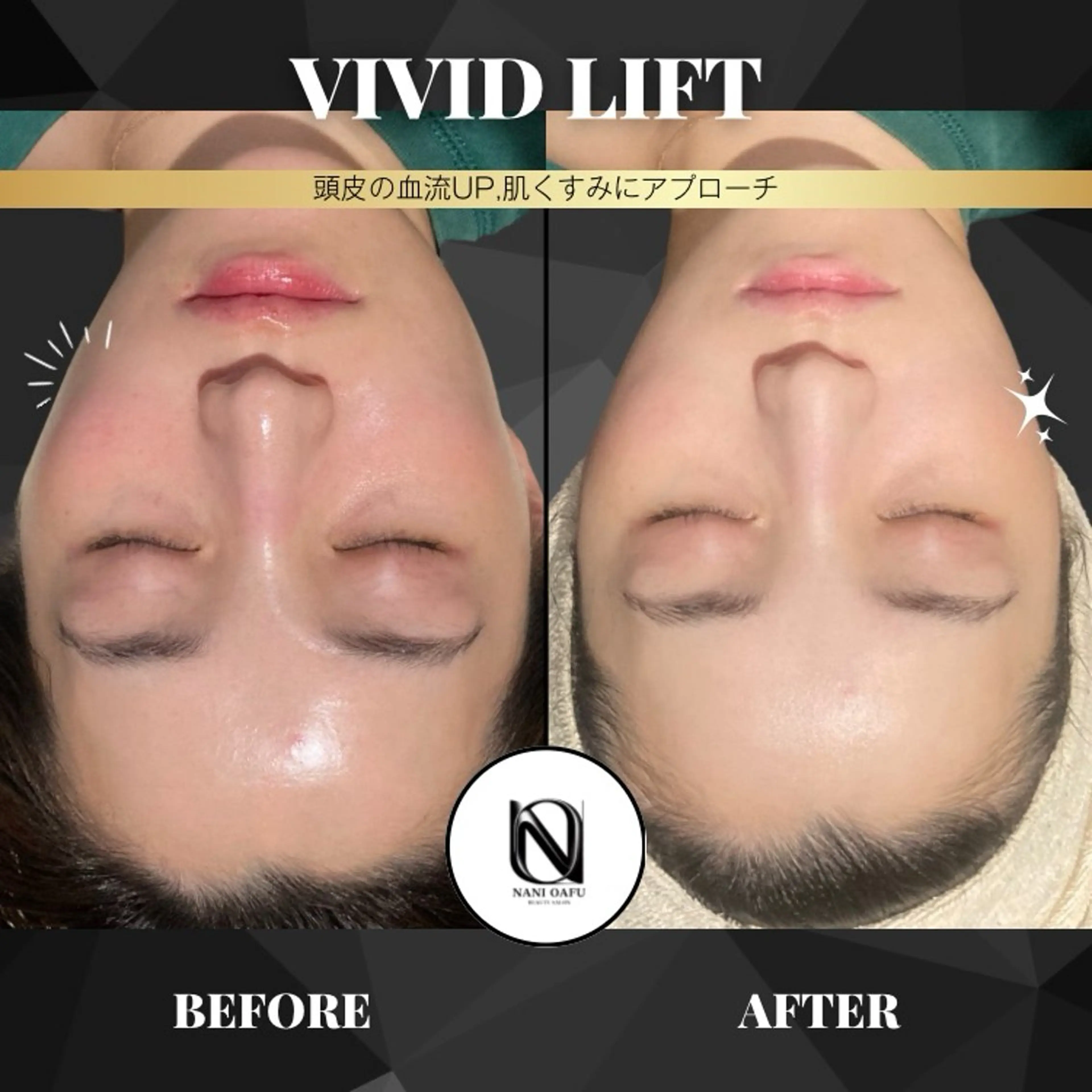 【🧖‍♀️頭皮×表情筋リフトケア】VIVID LIFT｜肌悩みにも応えるWアプローチ〈都度払いOK〉の写真