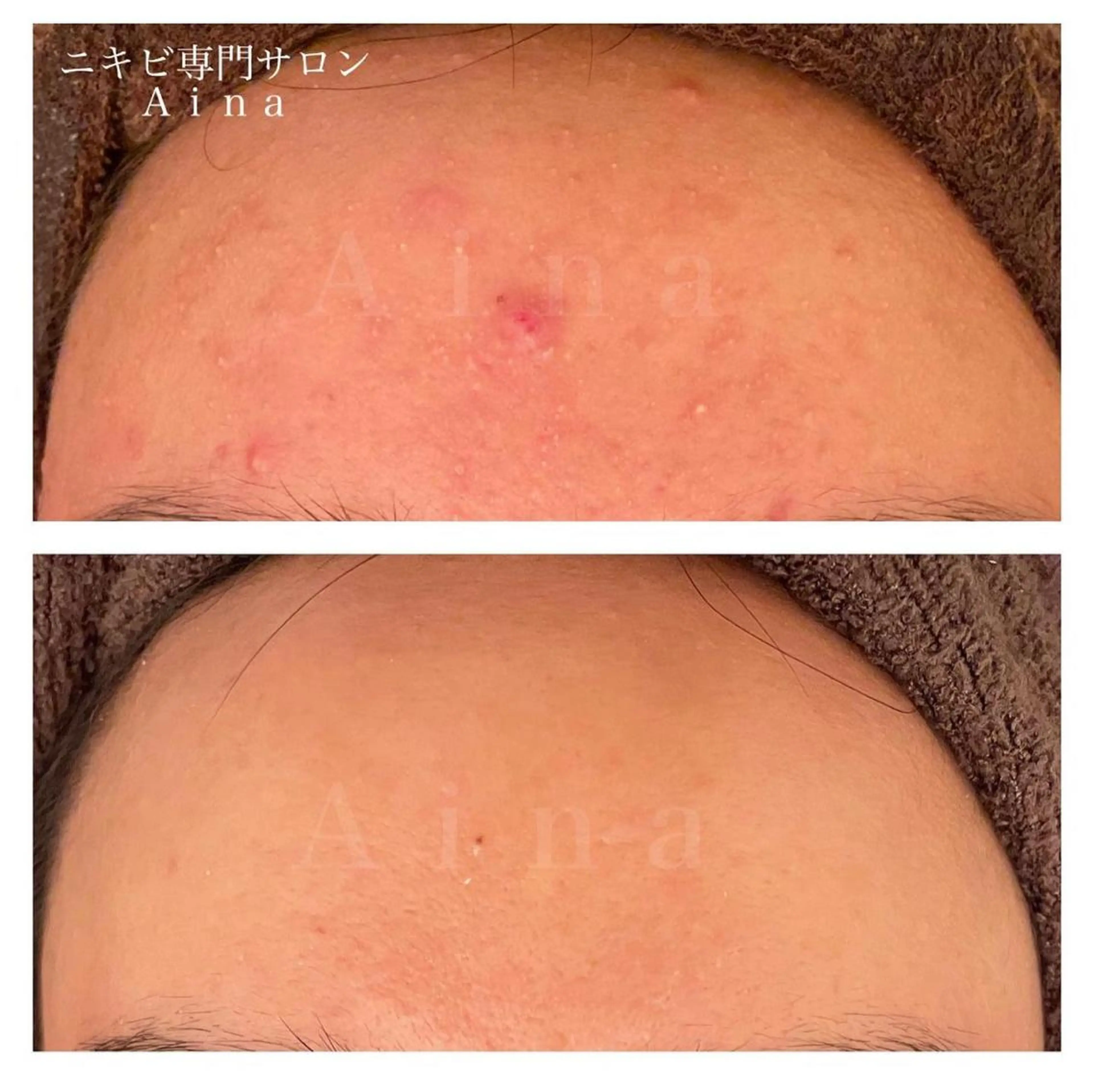 セミロング パーマ ヘアアレンジ メンズ キッズ ネイル マツエク・マツパ アイブロウ エステ リラク ニキビ跡専門サロン Ａｉｎａのエステ・リラクイメージ