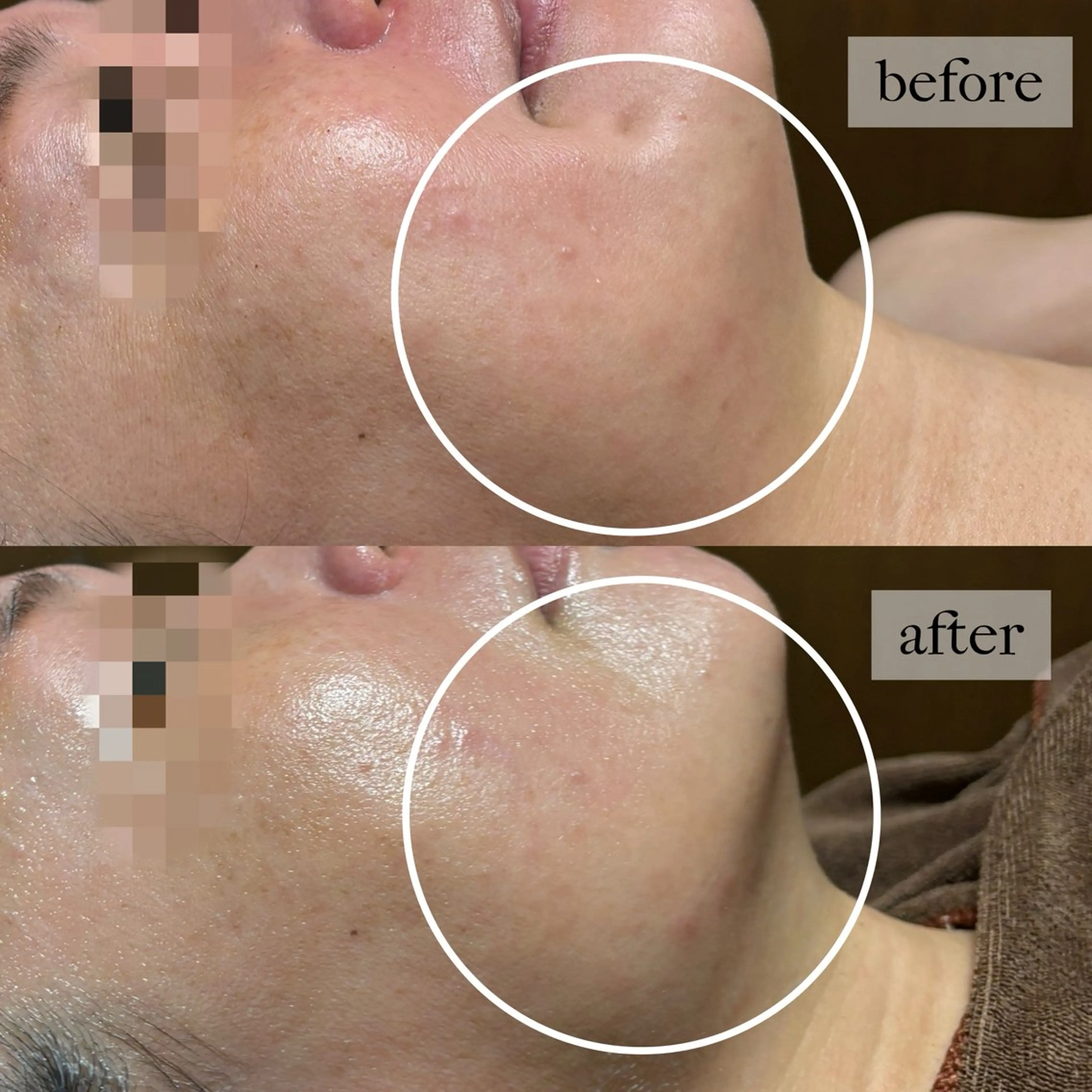 HINANO矢場町店【ヒナノ】所属・脱毛/肌改善🌿 HINANO 村田のエステ・リラクイメージ