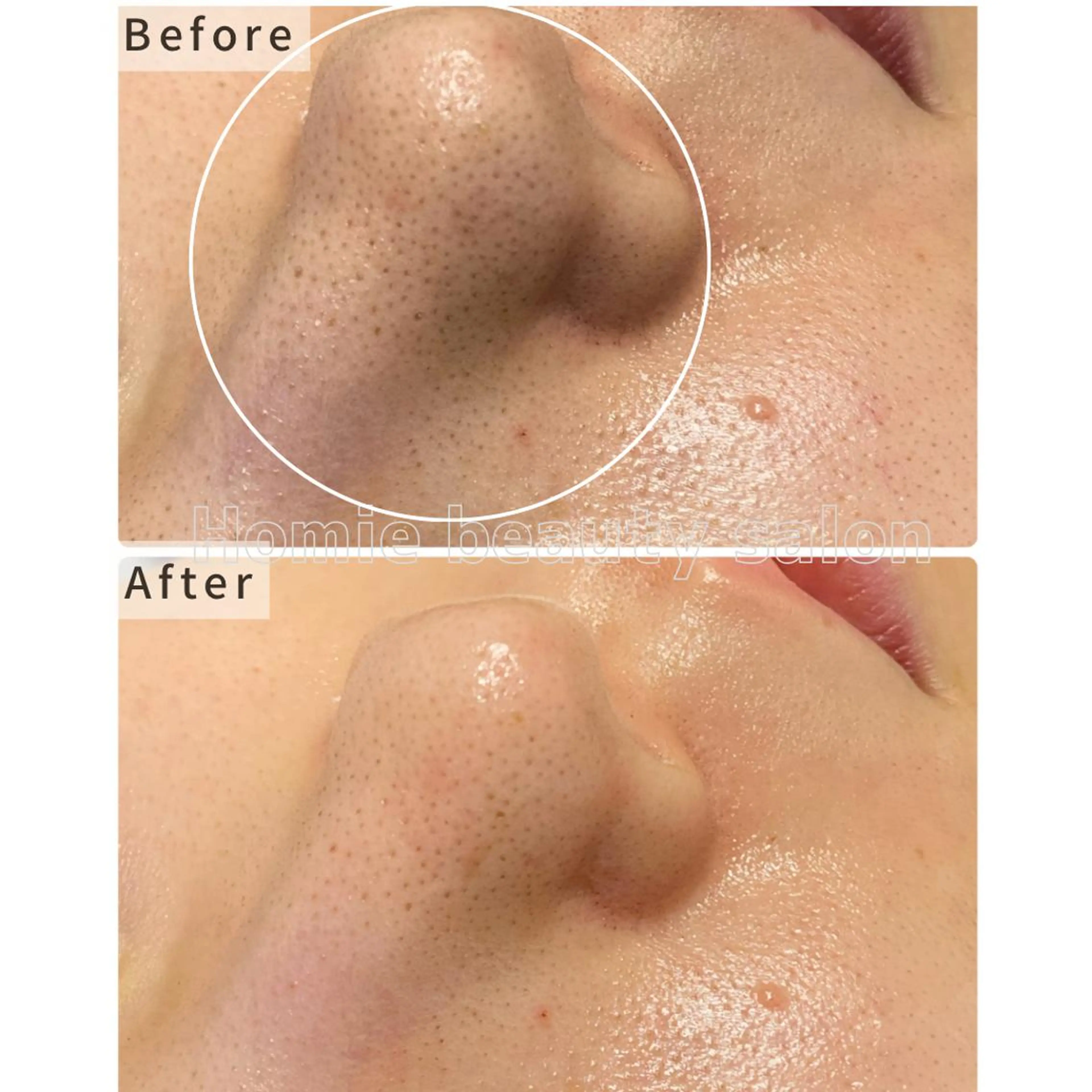 【人気NO.1*】毛穴洗浄×美肌ハーブピーリング(ヘッドスパ付) ¥15400→¥10000の写真