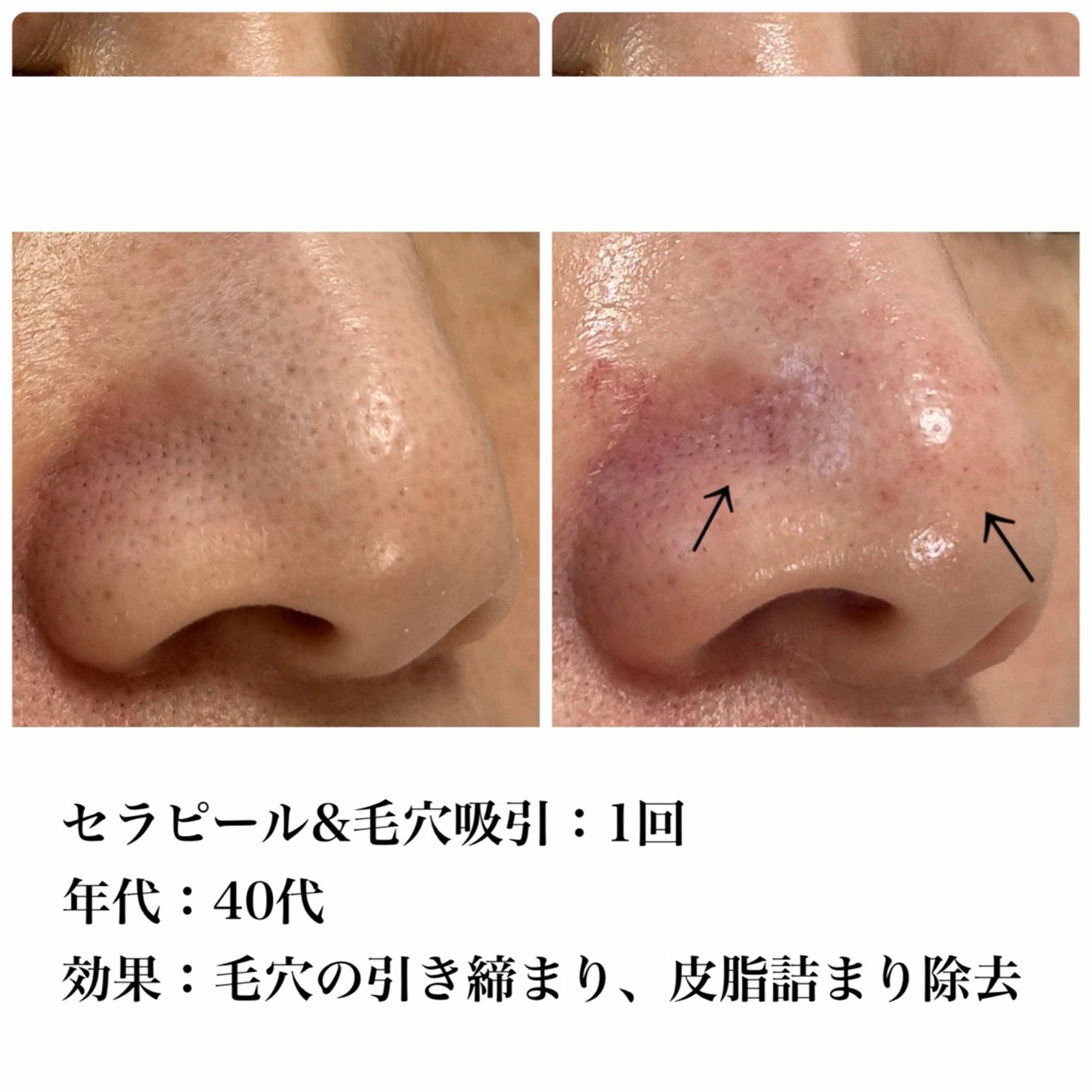 【🕐平日限定】毛穴洗浄×吸引✨黒ずみ・ざらつき集中ケア　¥5,500→の写真