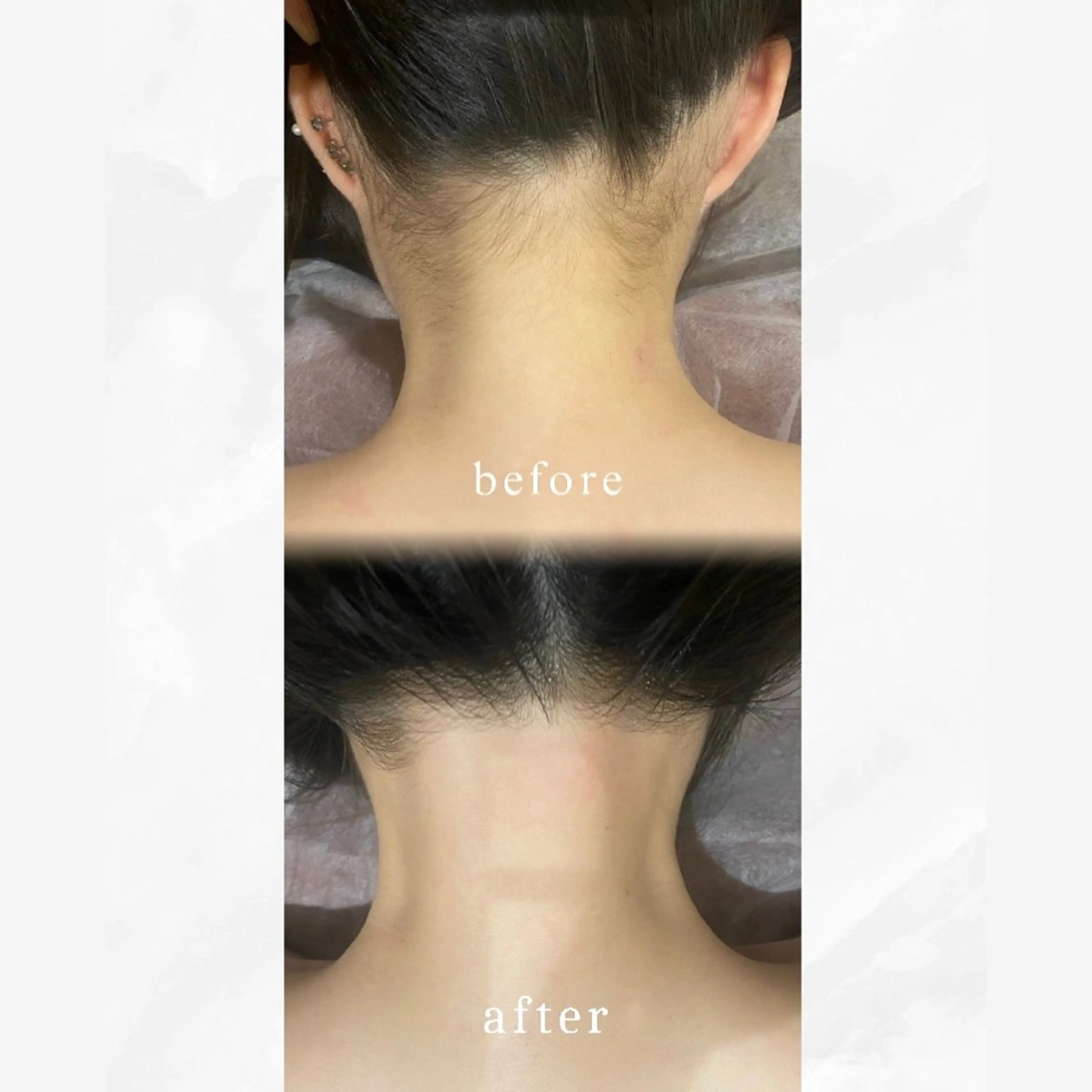 ㊗️成人式の方必見✨️うなじ広範囲とほほのハイブリッド脱毛💓もみあげ部分も綺麗に整えます😌の写真