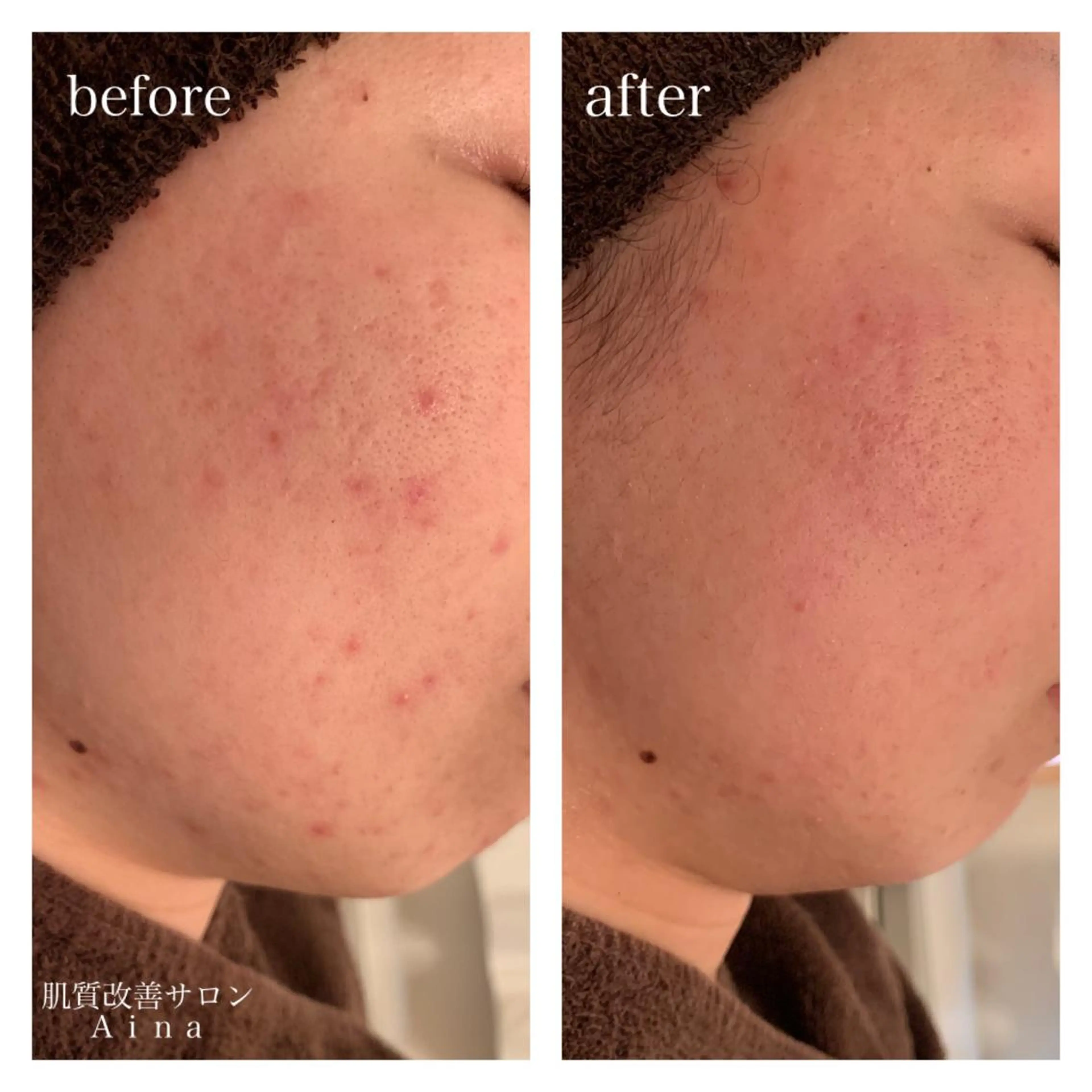 ミディアム カラー パーマ ヘアアレンジ メンズ キッズ ネイル マツエク・マツパ ニキビ跡専門サロン Ａｉｎａのエステ・リラクイメージ