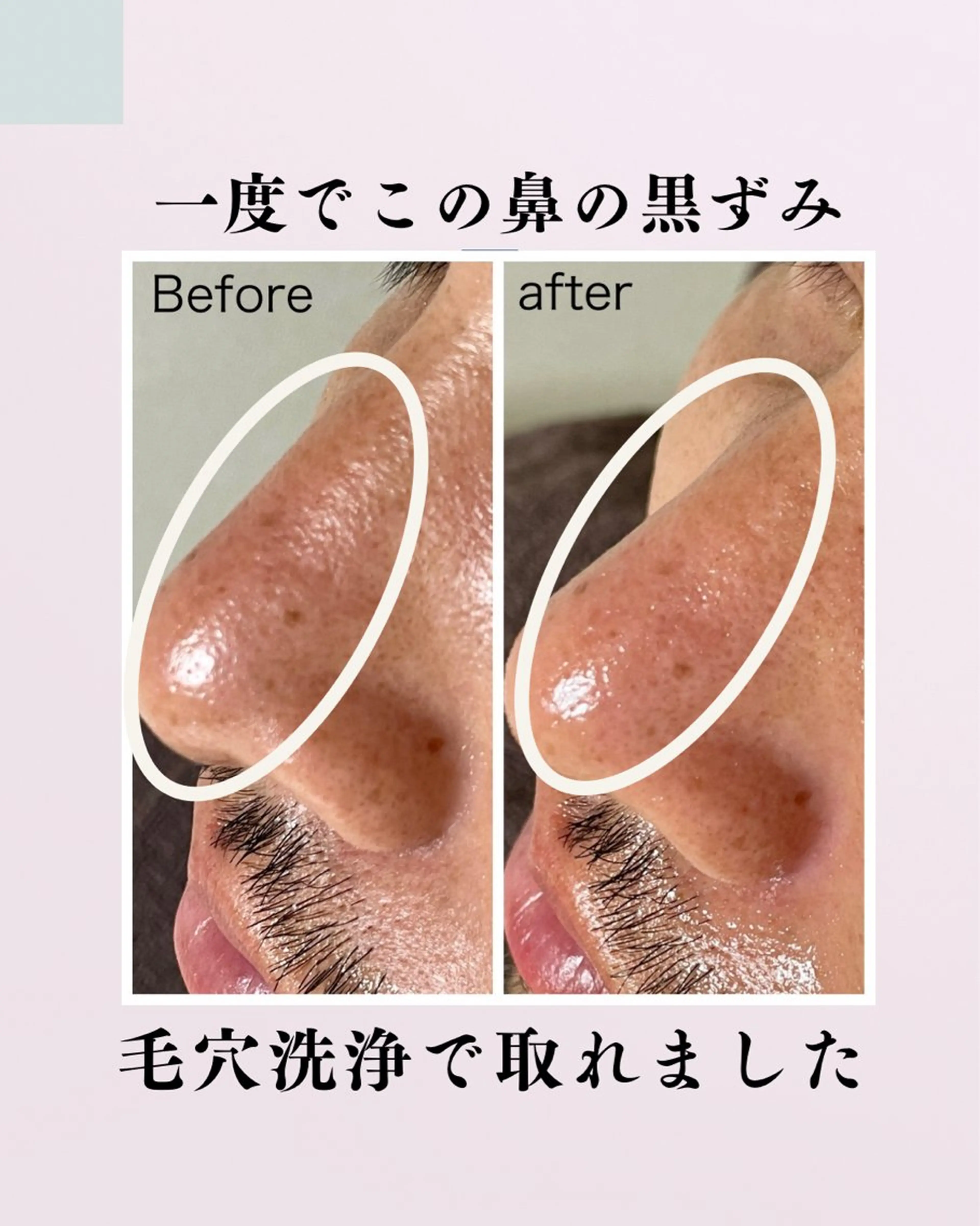 メンズ用👱🏻‍♂️毛穴洗浄/小顔/プラズマの写真