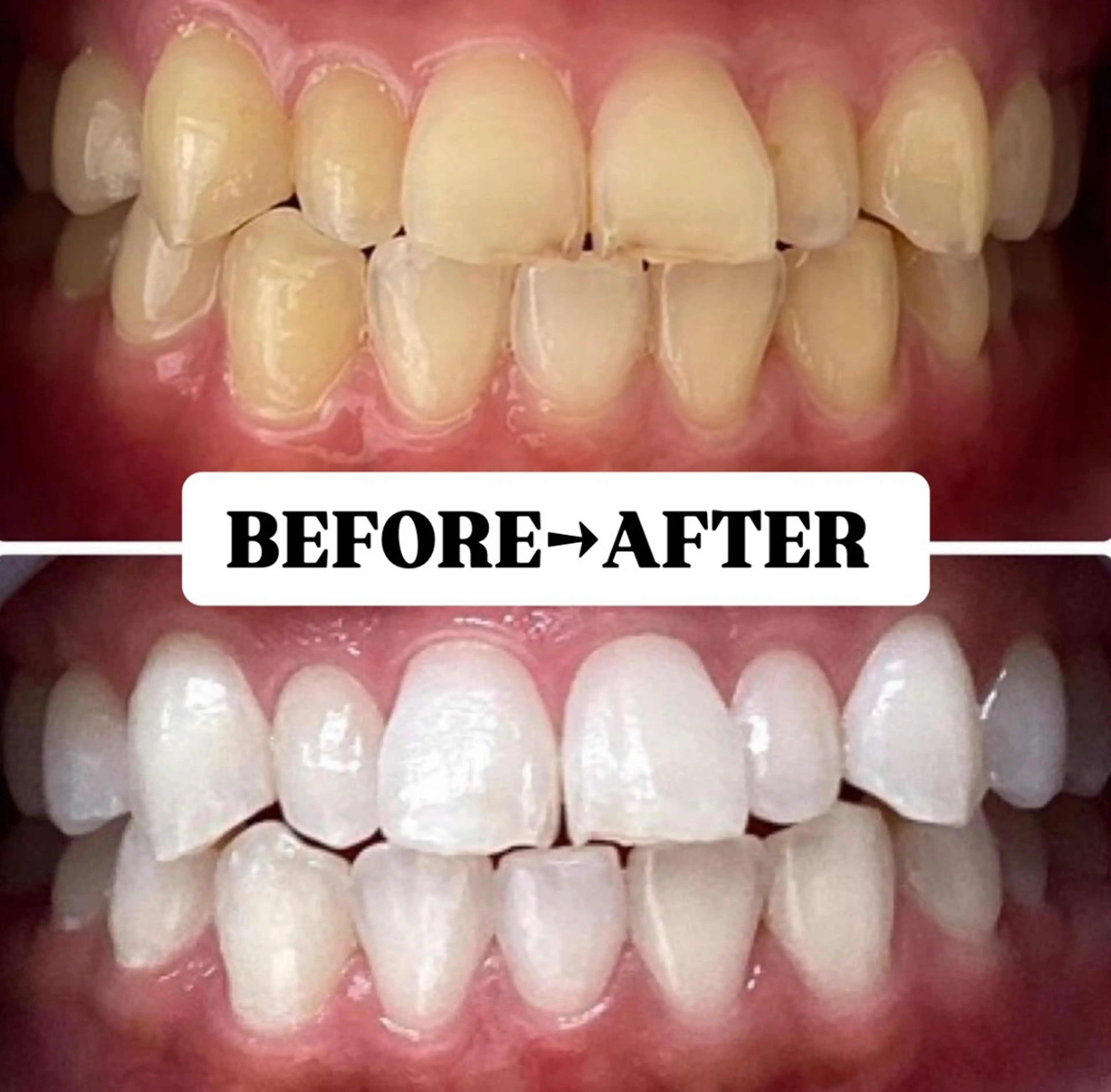 学割U24】【ミニモ学割♪速攻効果実感】 美白ホワイトニング 20分×2回照射¥2000✨の写真