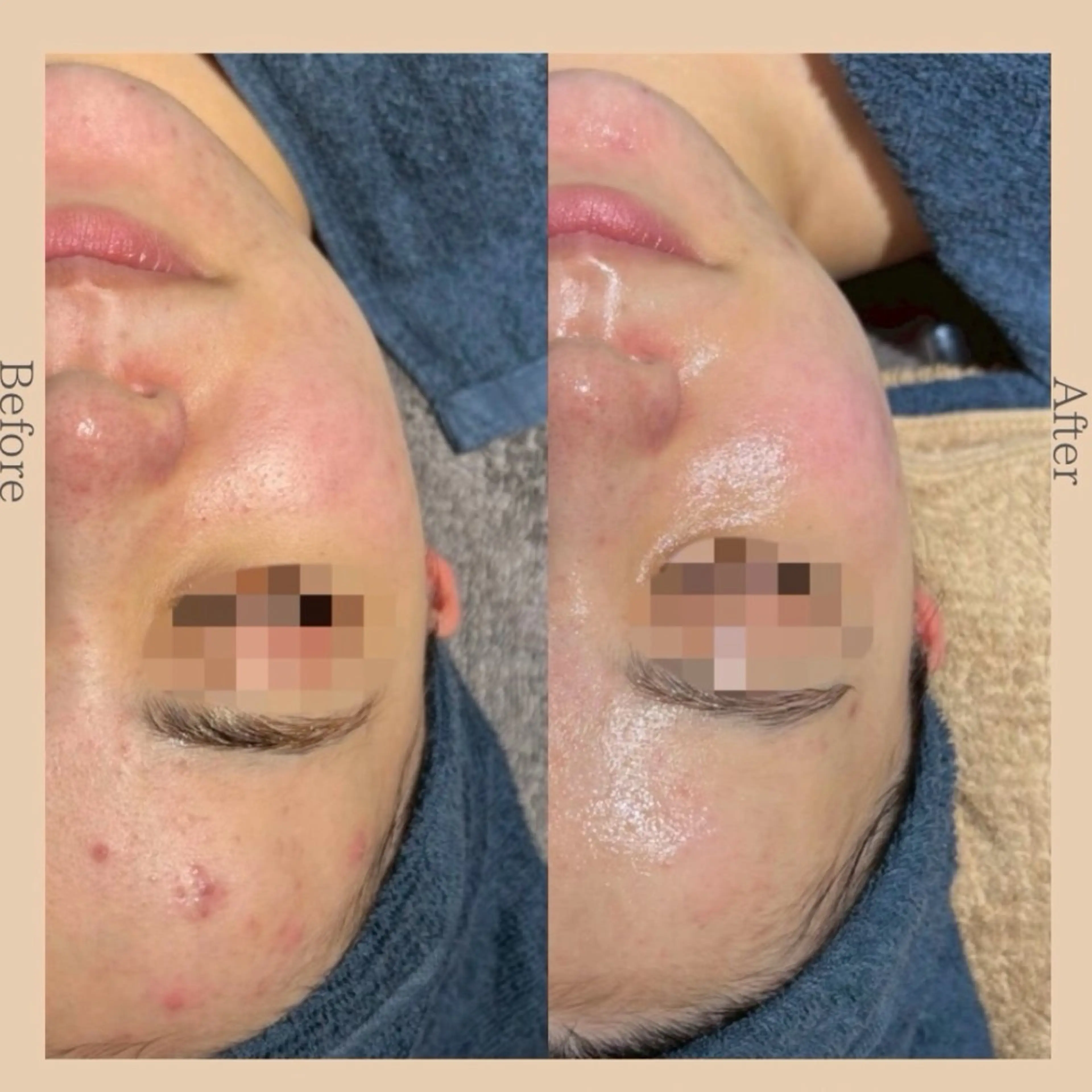 美肌脱毛&フェイシャルサロン HAJU所属・森川 瑶のエステ・リラクイメージ