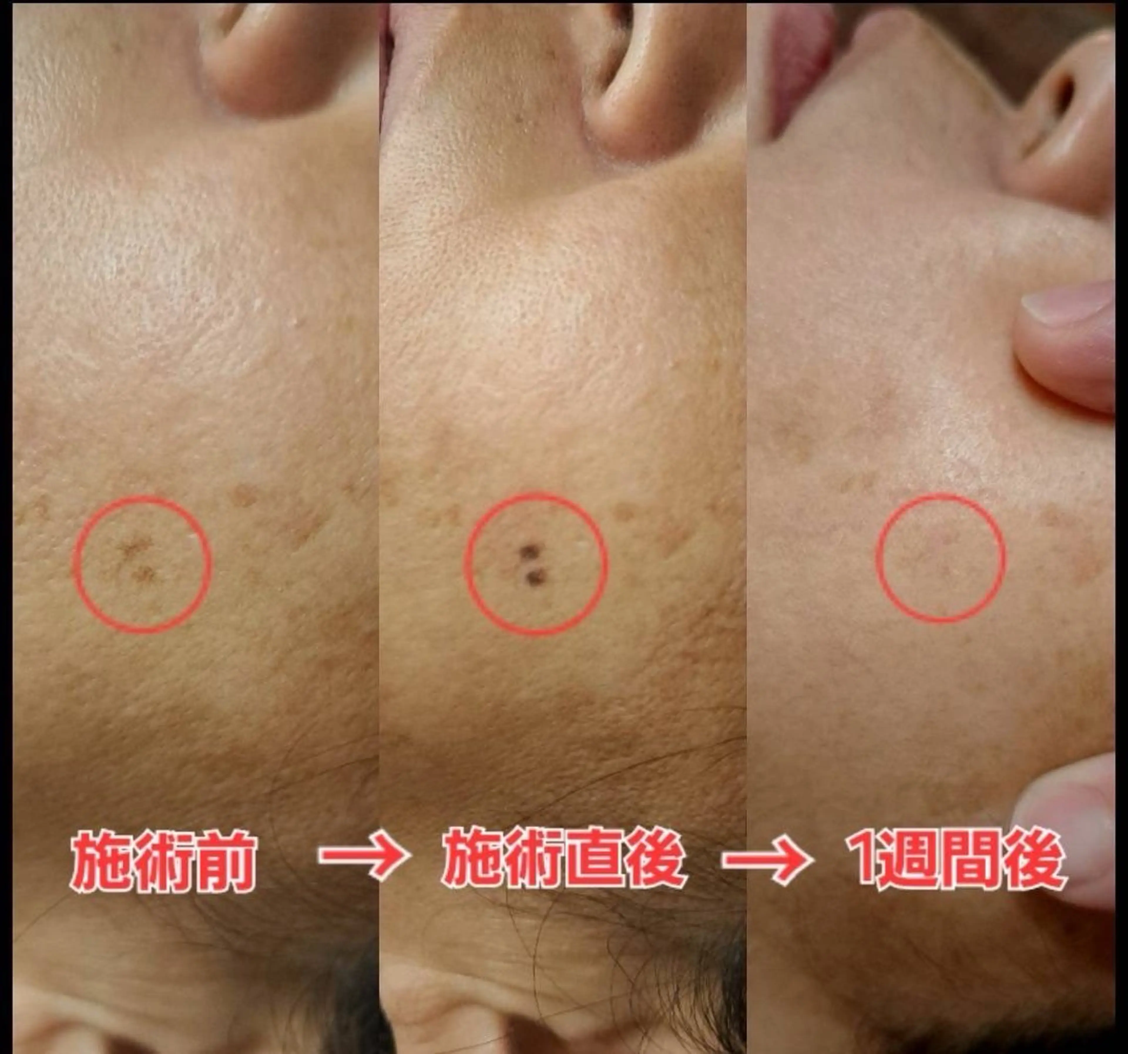 しみケアデトックス15分の写真