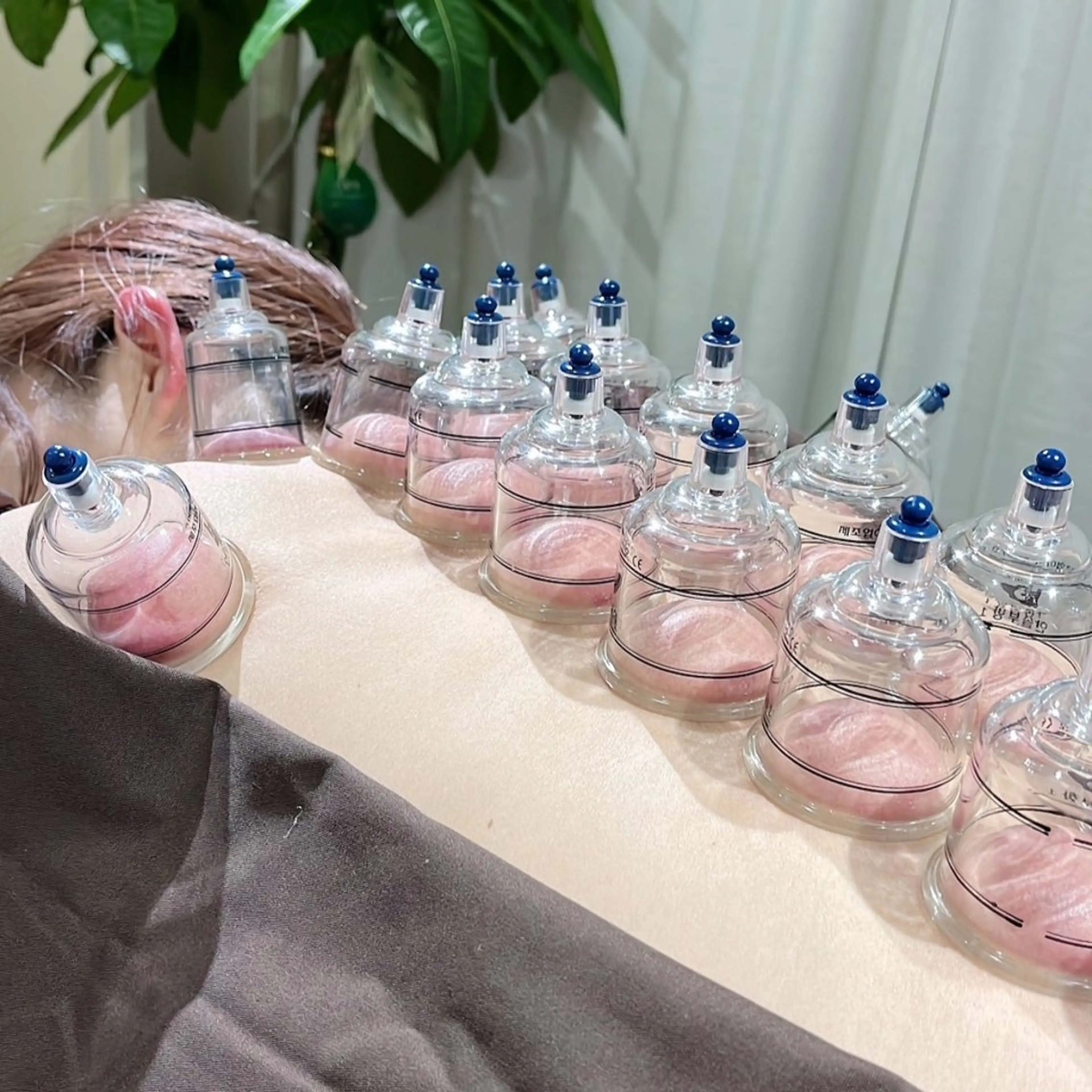 鍼施術(全身)+パルス(電気鍼)+吸玉(カッピング)+マッサージの写真