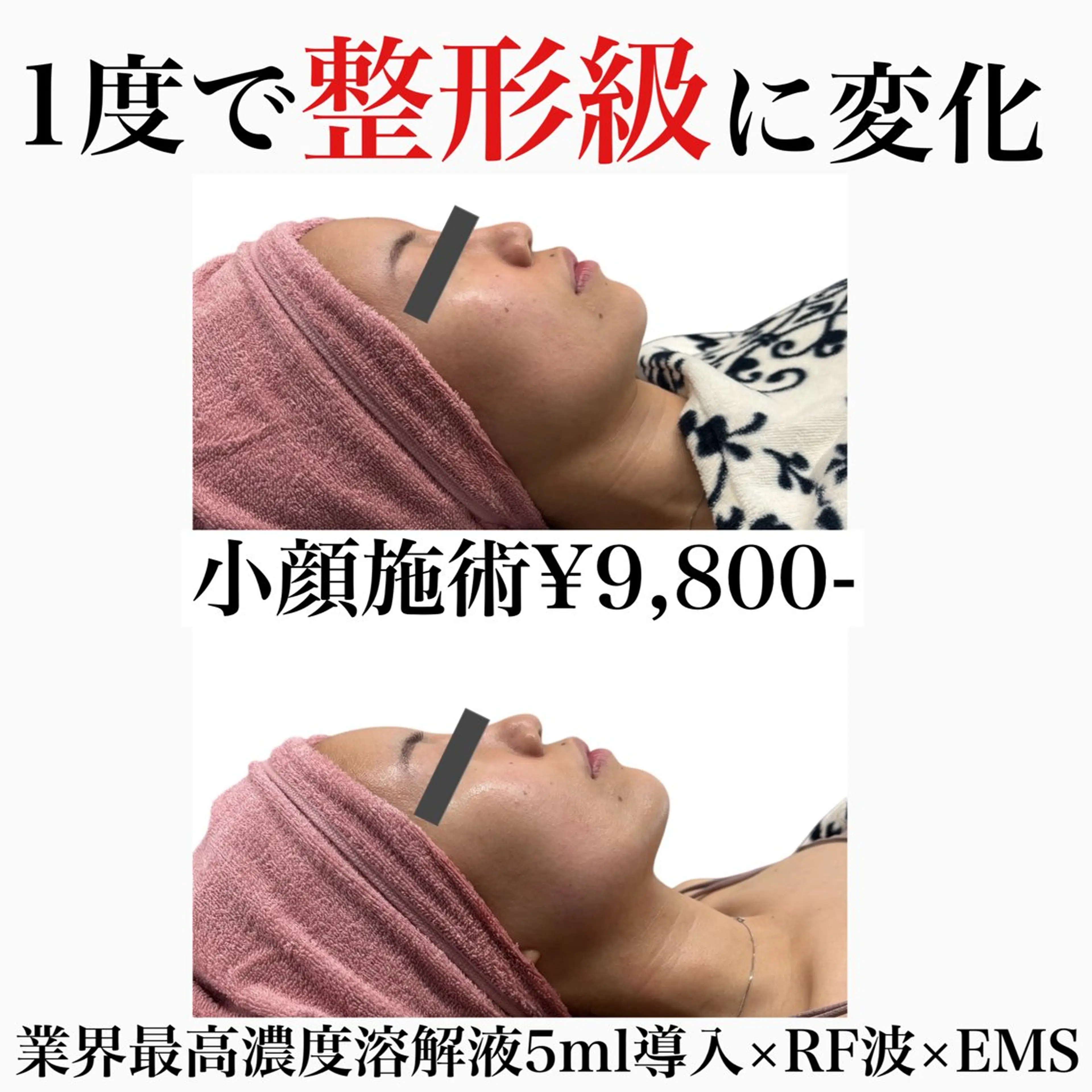 『人気No.1🩷整形級小顔施術』業界最高濃度溶解液5ml導入×RF波×EMSの写真