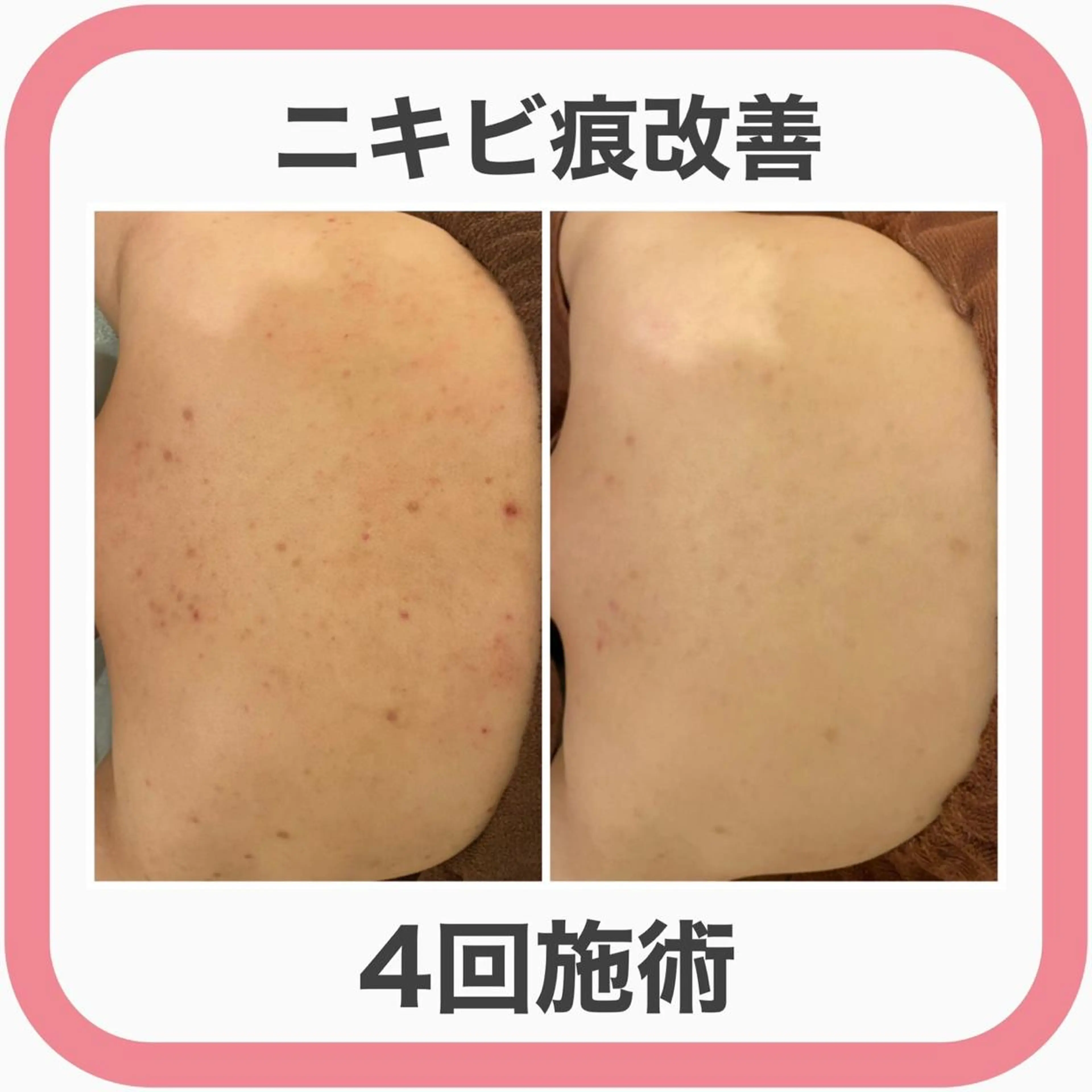 12月平日限定価格❣️ハーブピーリングより優しい低刺激ピーリング&温熱イオンロウパック🍯お背中の肌荒れ集中ケア🧚✨の写真