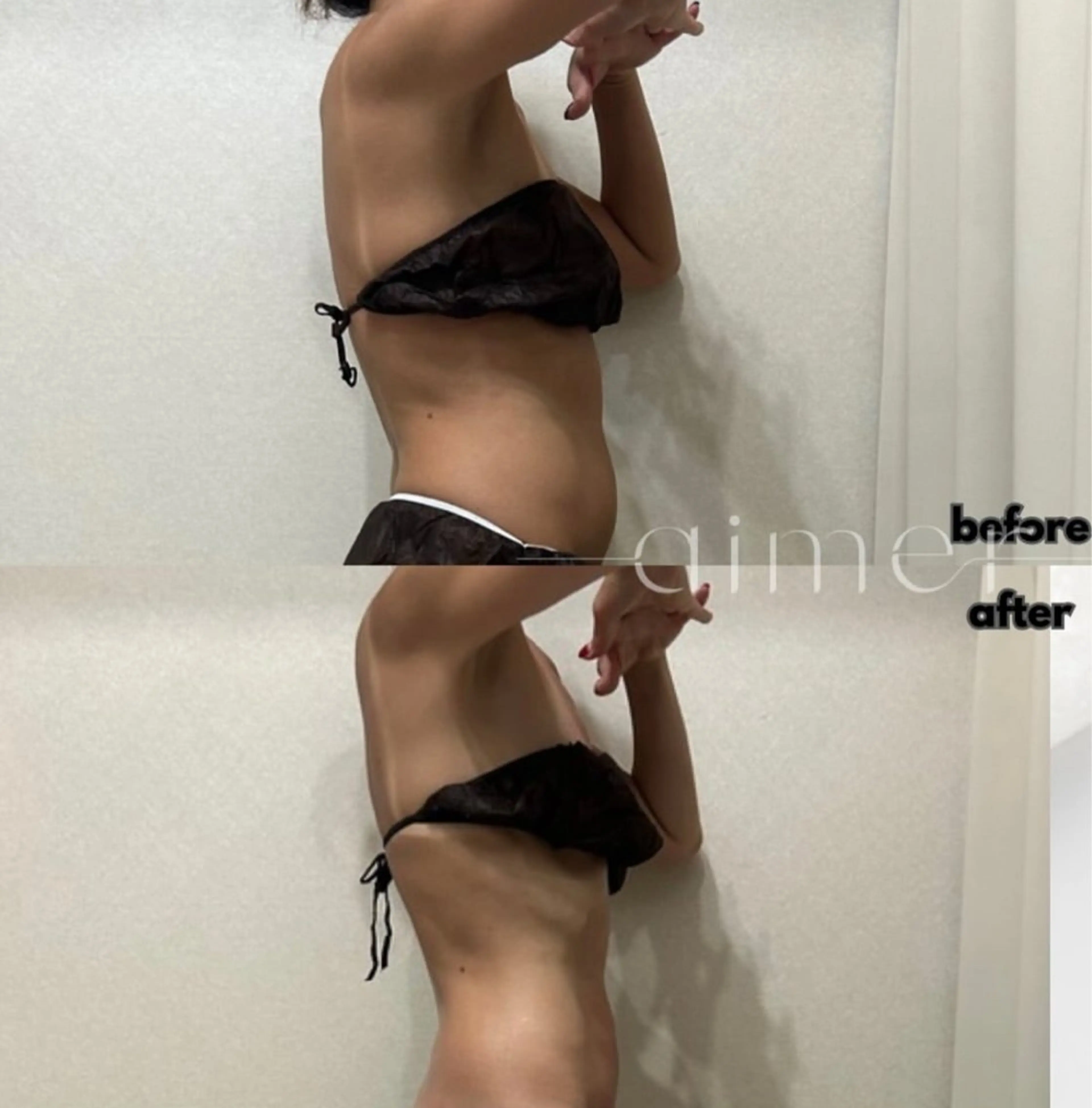 💆🏼‍♀️半身+デコルテ🫧ハイパーナイフ×リンパマッサージの写真