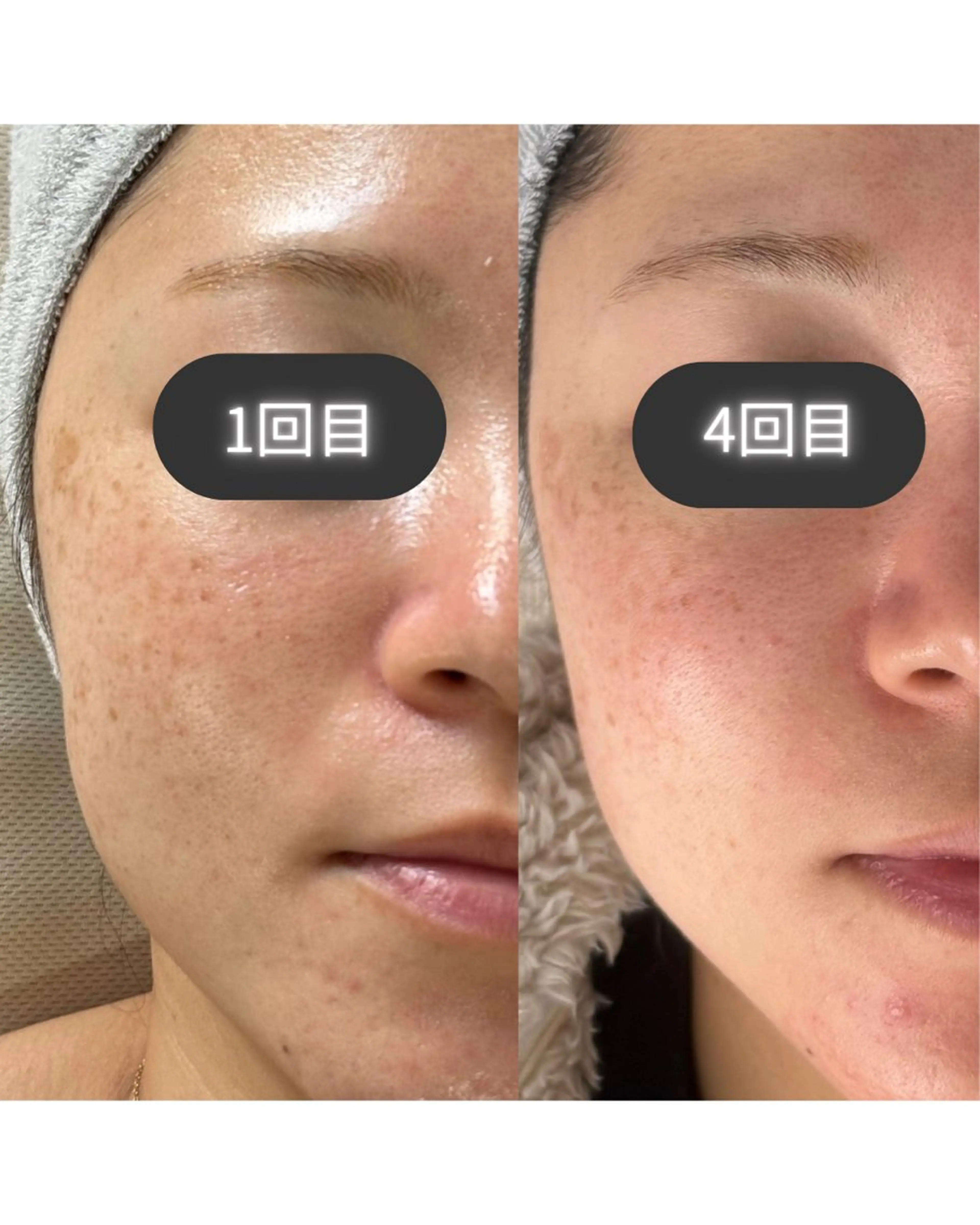 【福袋A】シミ/シワ/たるみ/毛穴◎最強肌質改善セット3回券★通常→¥60,600の写真