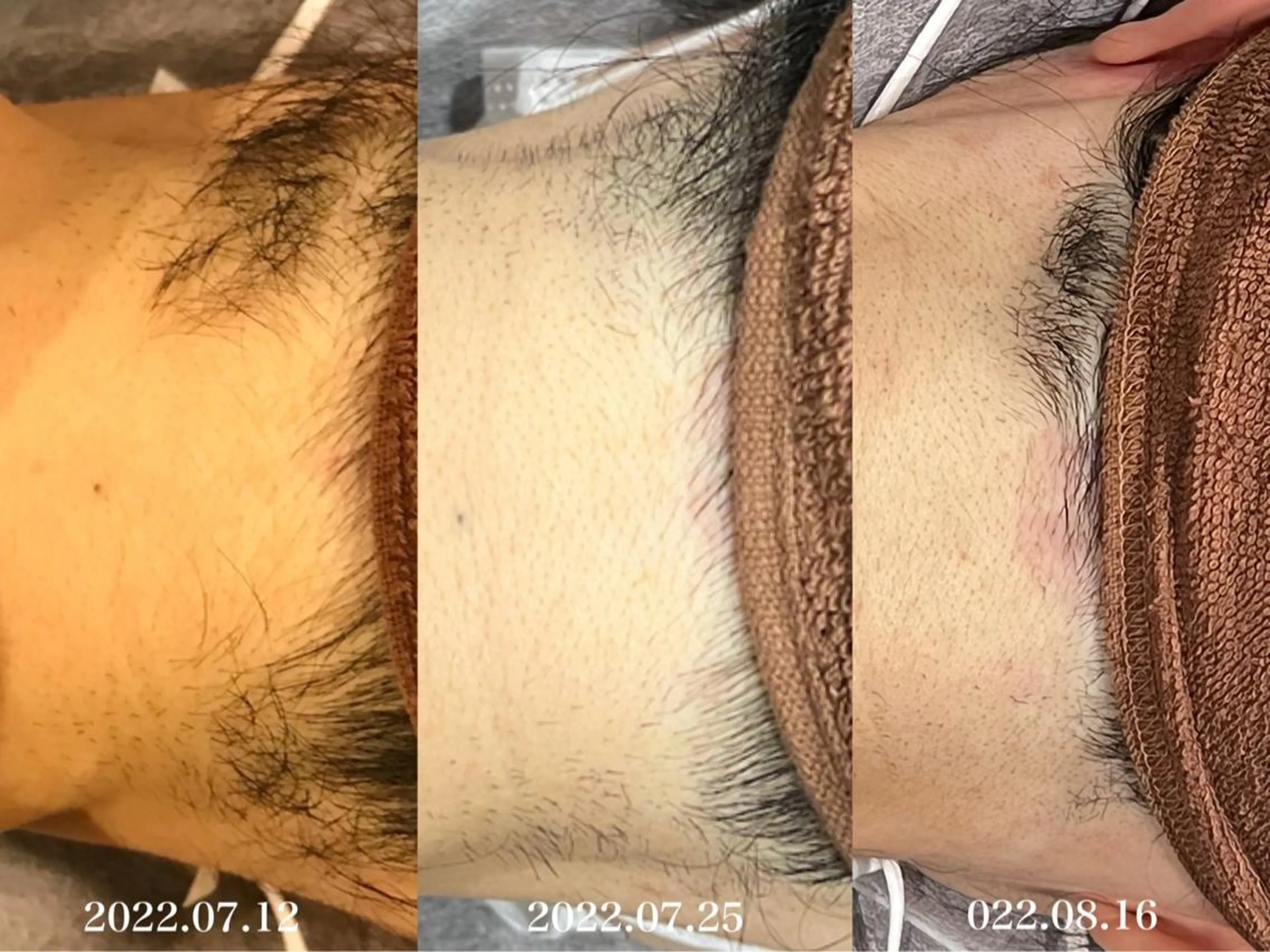 脱毛 ULULU上野店所属・ULULU 上野店のエステ・リラクイメージ