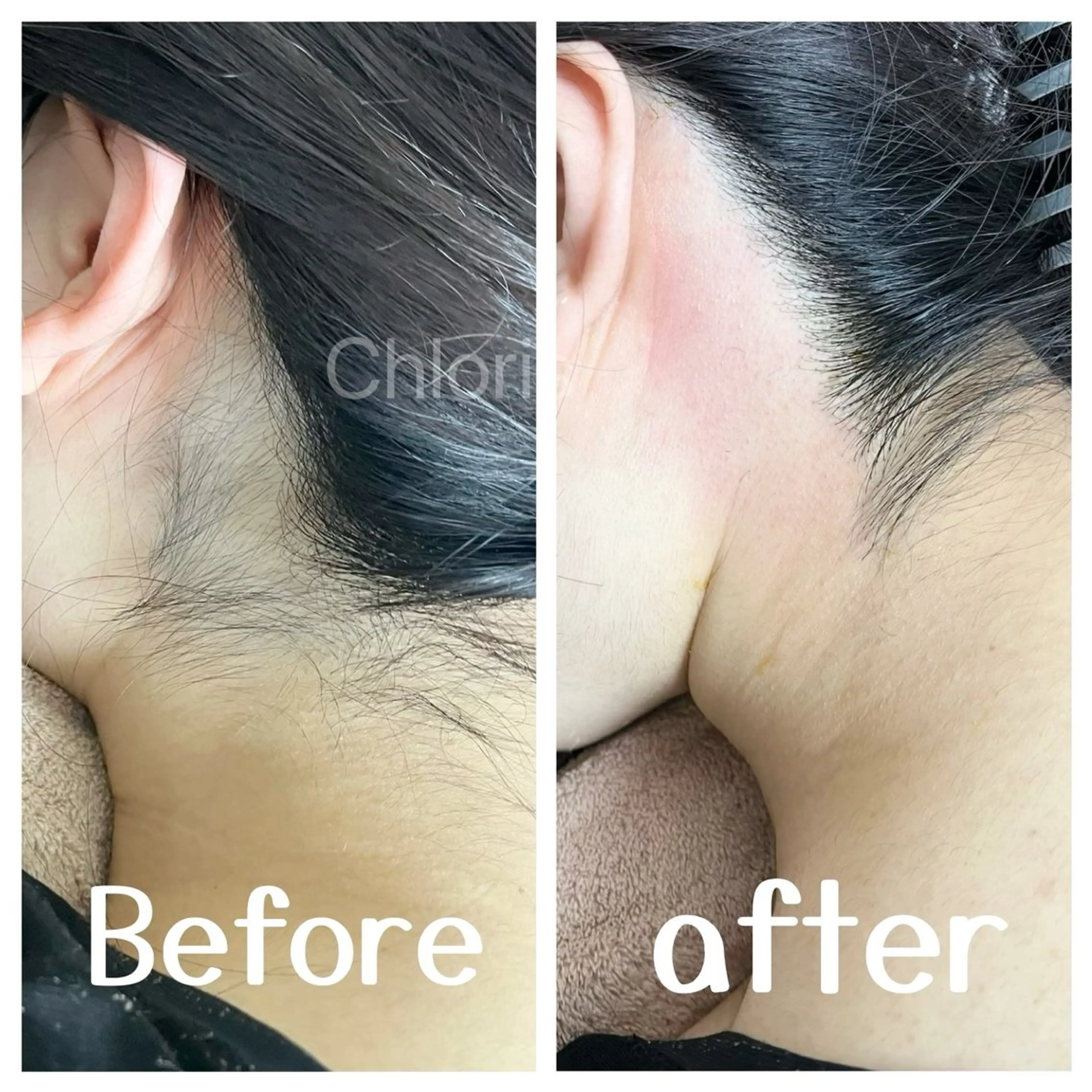 【初回限定】　【Wax脱毛】うなじケアの写真