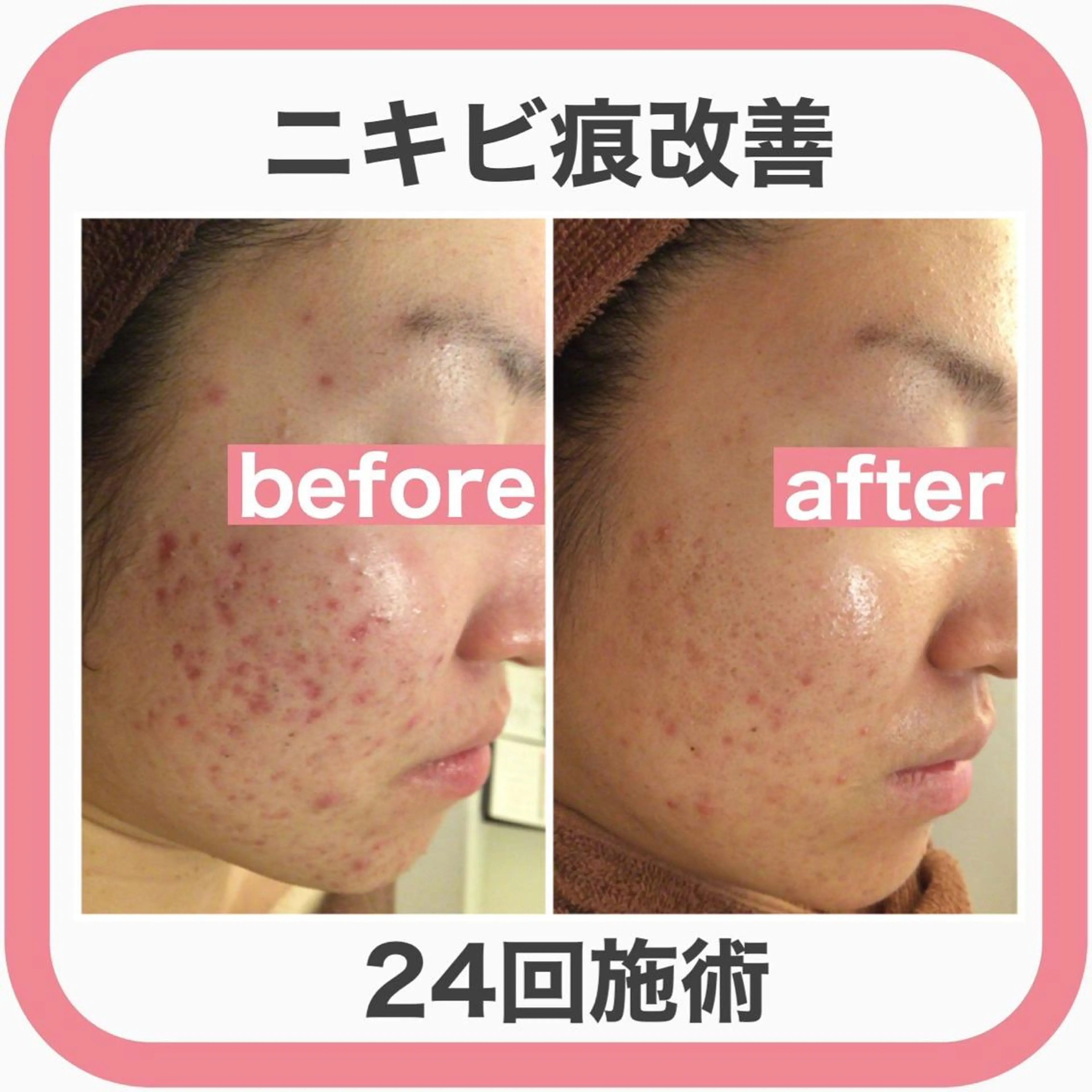 セミロング カラー パーマ ヘアアレンジ メンズ ネイル マツエク・マツパ アイブロウ 🔥3か月で肌革命 🔥ニキビ専門店のエステ・リラクイメージ