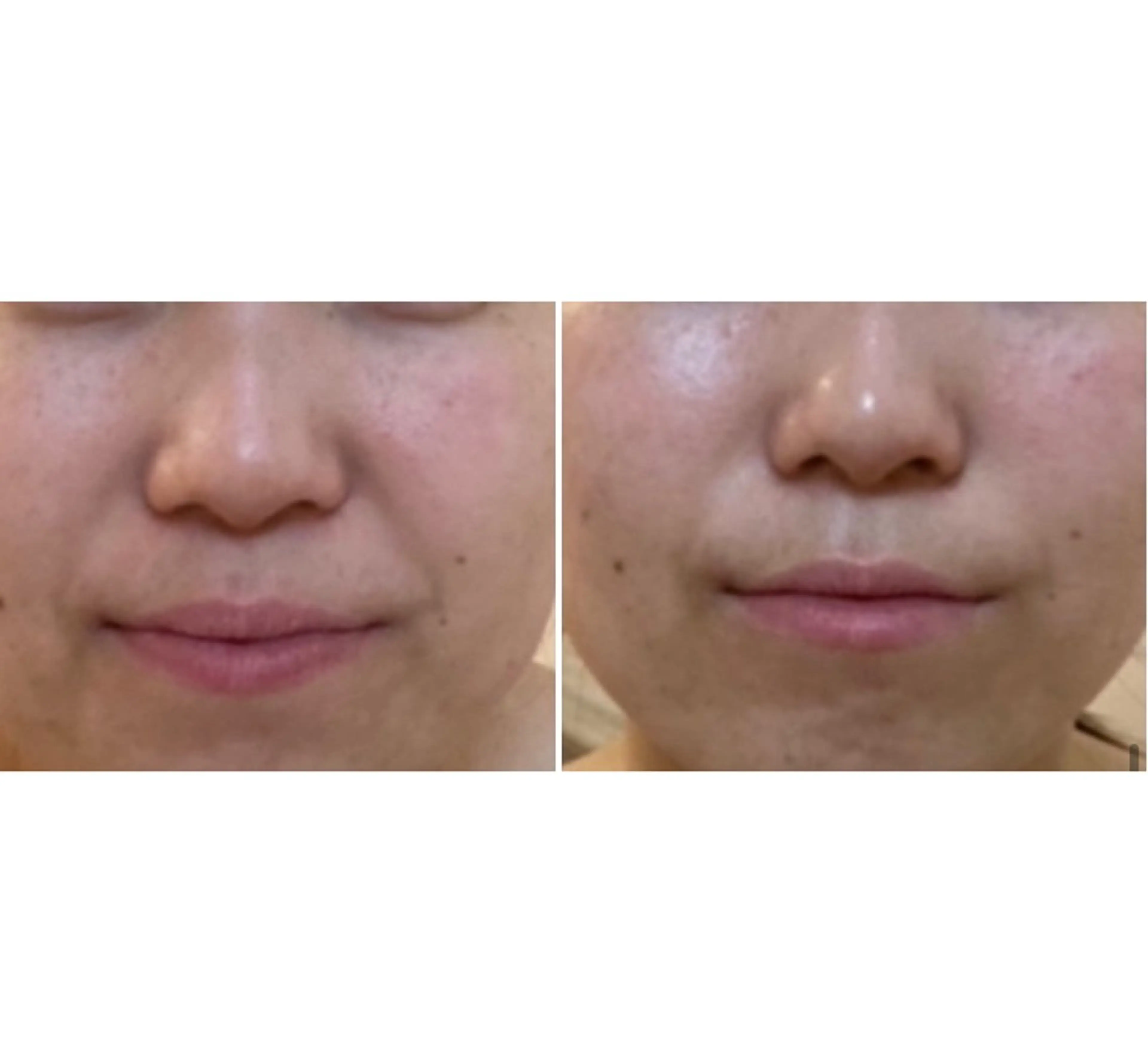 ついに発表❗️エステ後が楽しみ❗️シワ対策パック付き初回お試し❤️シワ、と言いますが、20代の子達にも大人気！の写真