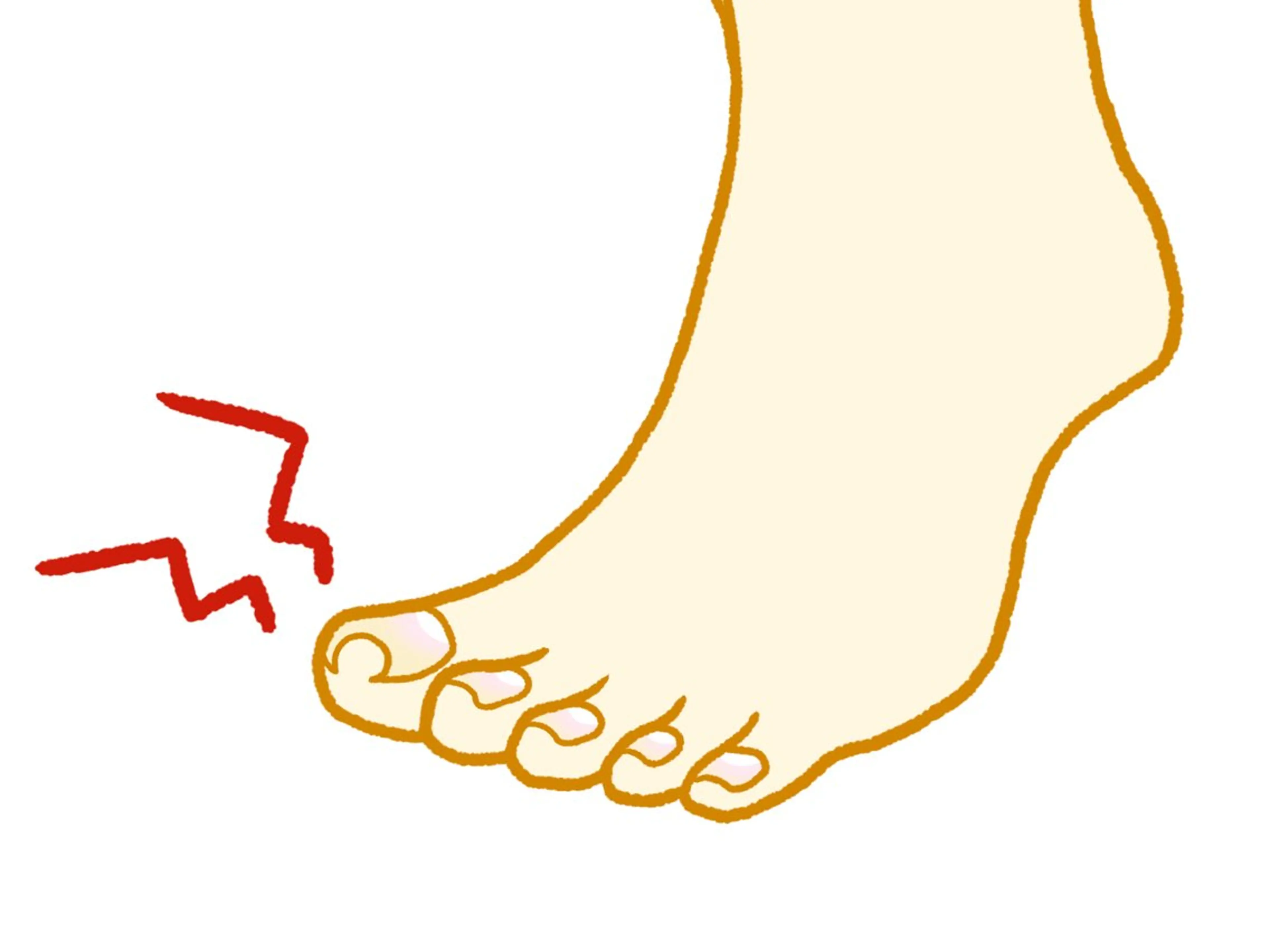 巻き爪補正の写真