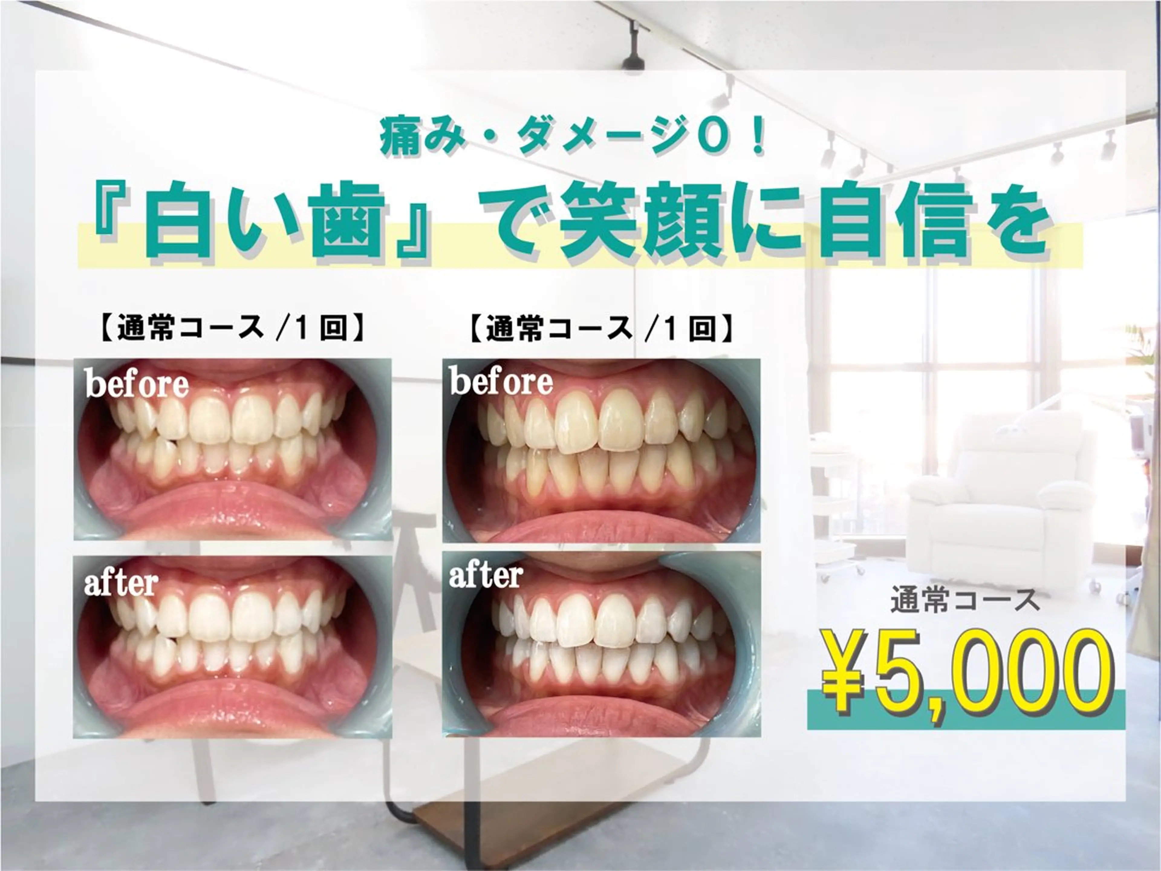 【ホワイトニング】通常コース40分照射 ¥5,000の写真