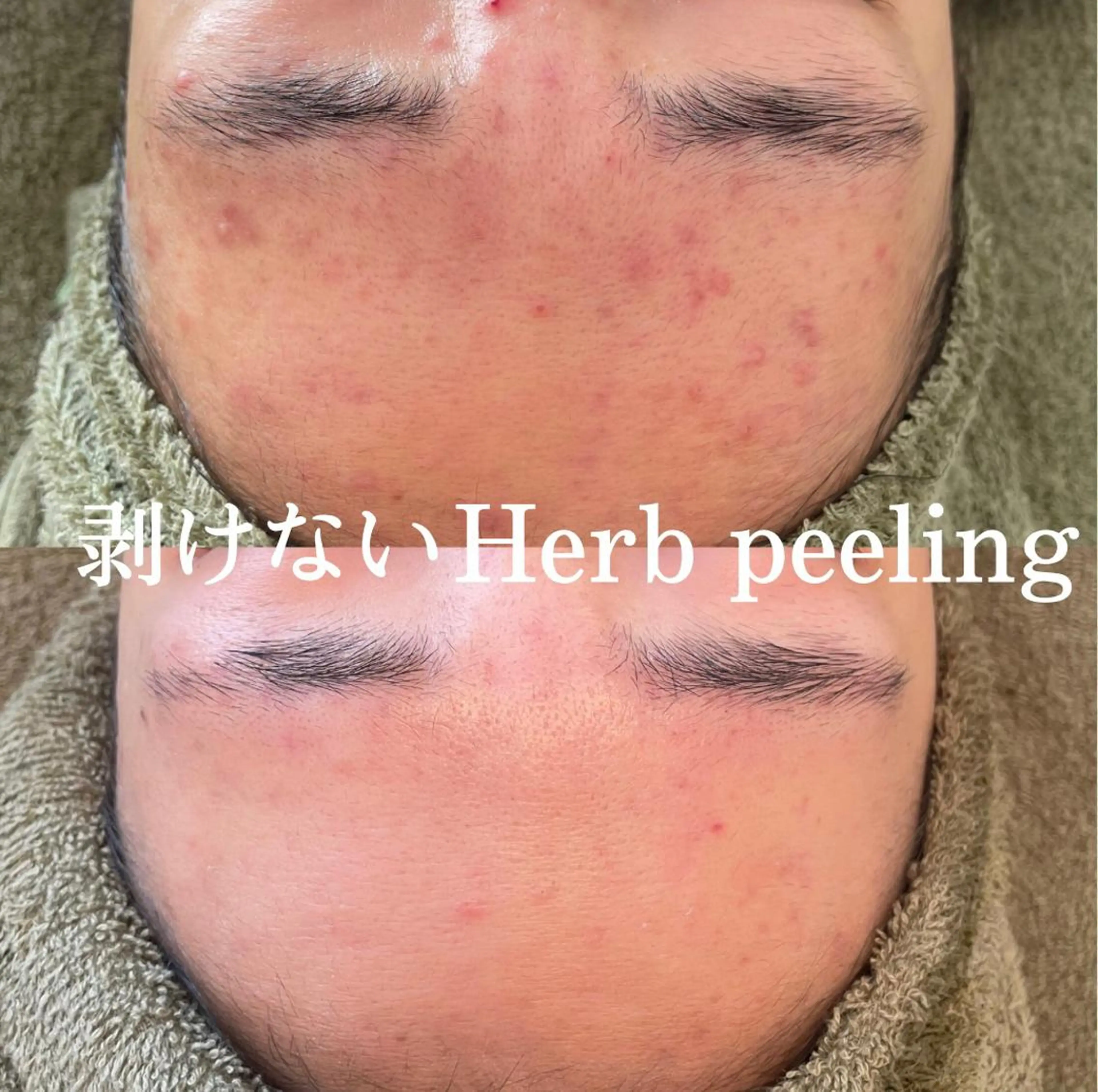 エステ ニキビ・毛穴改善 🌿ハーブピーリングのエステ・リラクイメージ