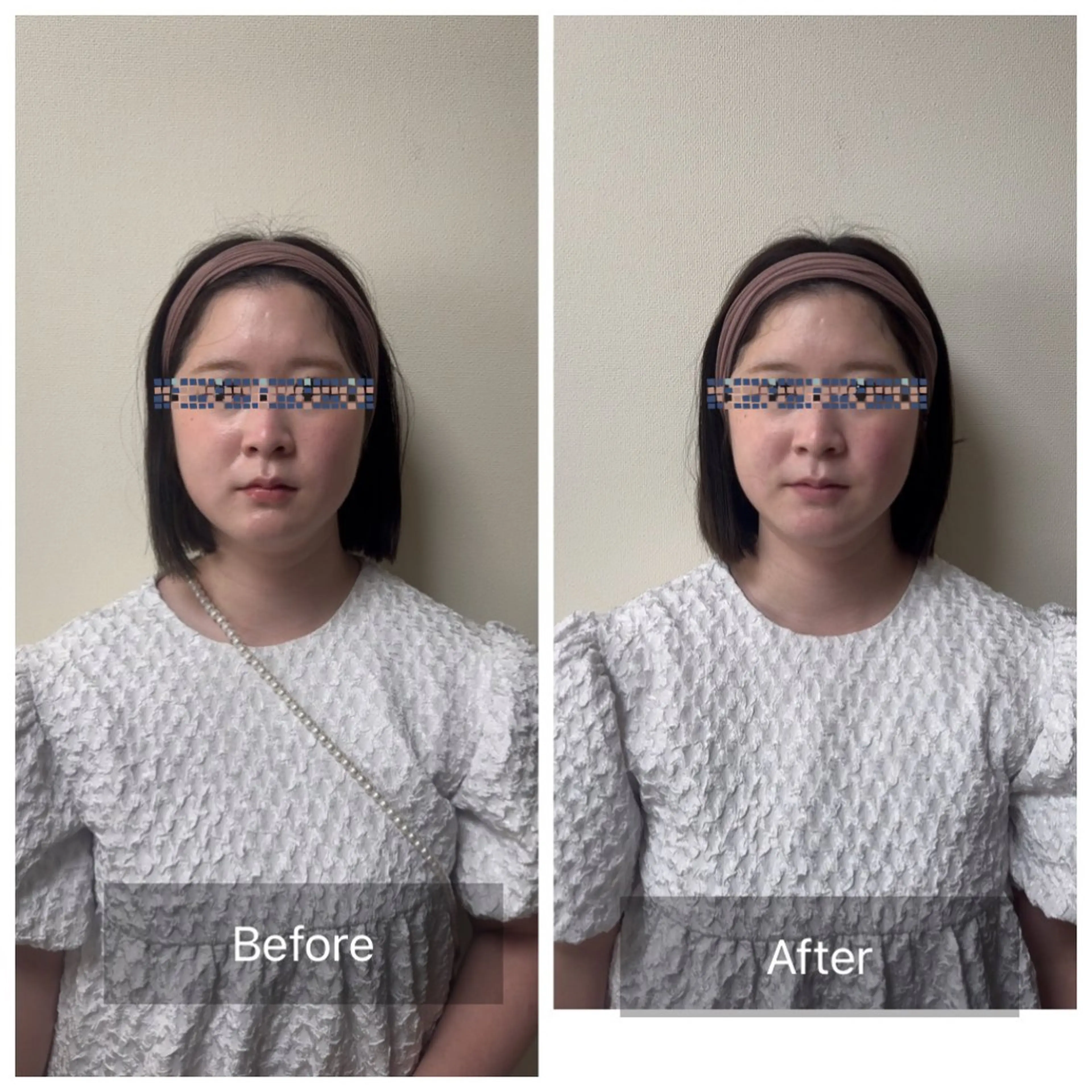 小顔整顔【印象美】リノベーションリフトの写真