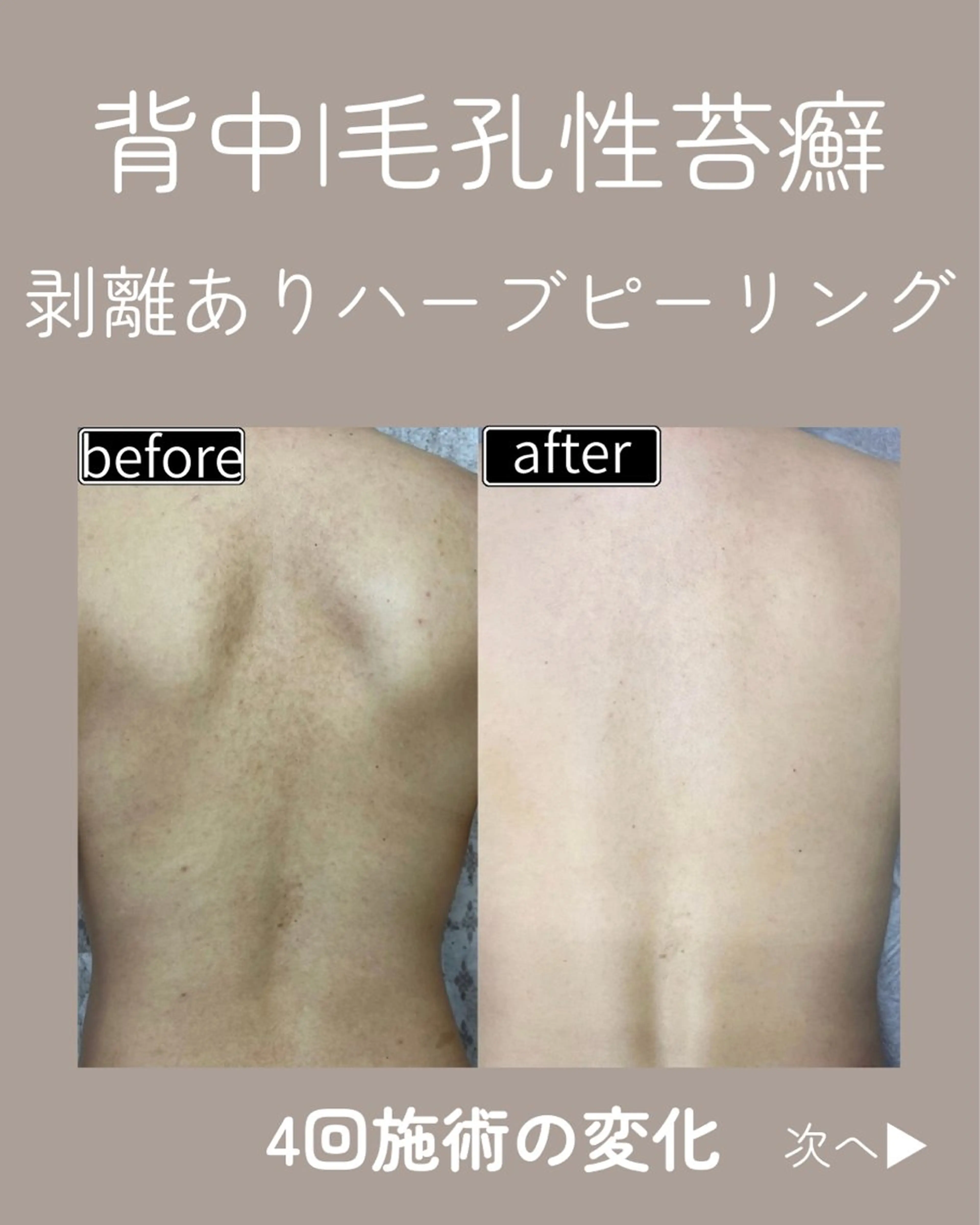 【背中全体】剥離ありハーブピーリング🌿ニキビ・ニキビ跡・ぷつぷつ・黒ずみの写真