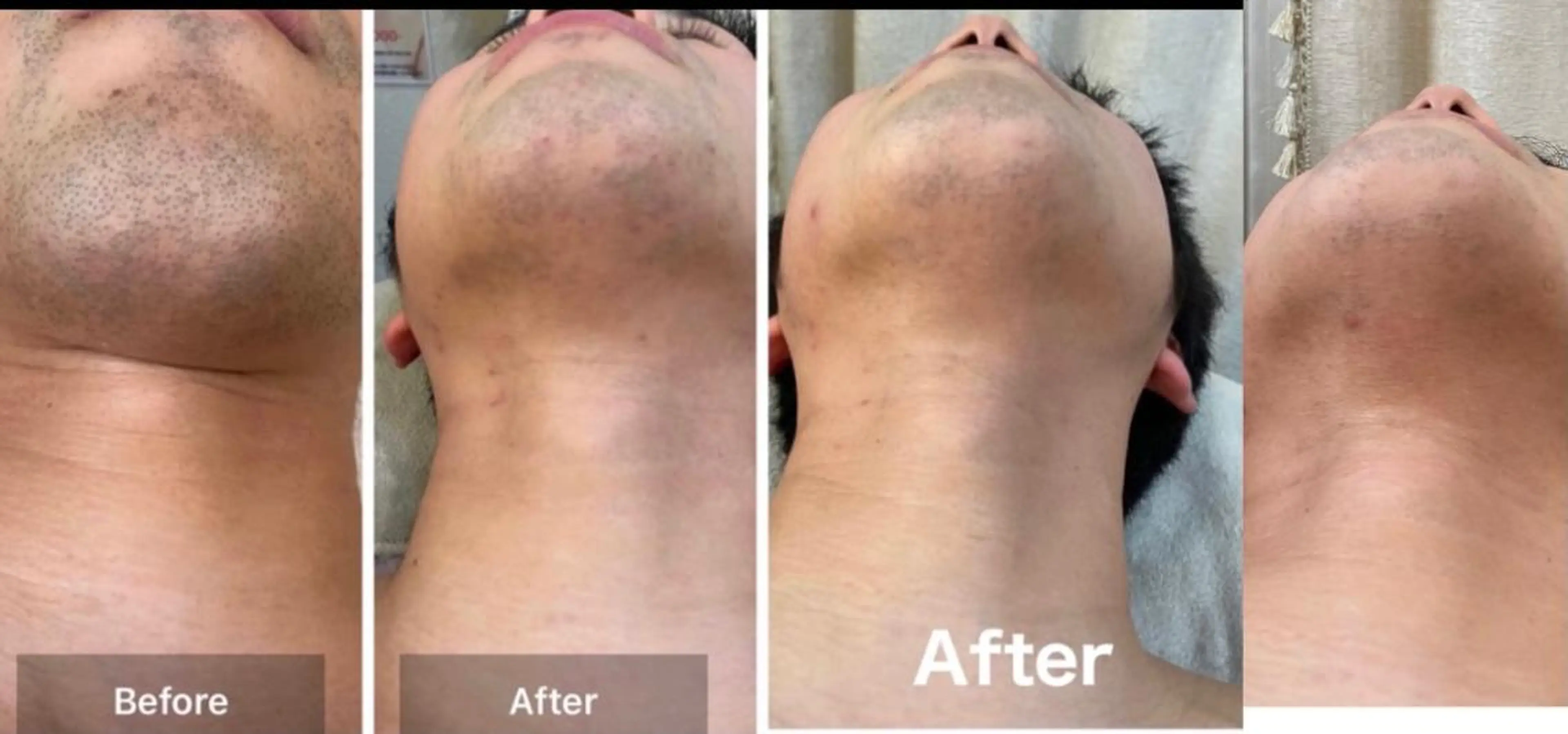 飛び出すヒゲ脱毛！の写真