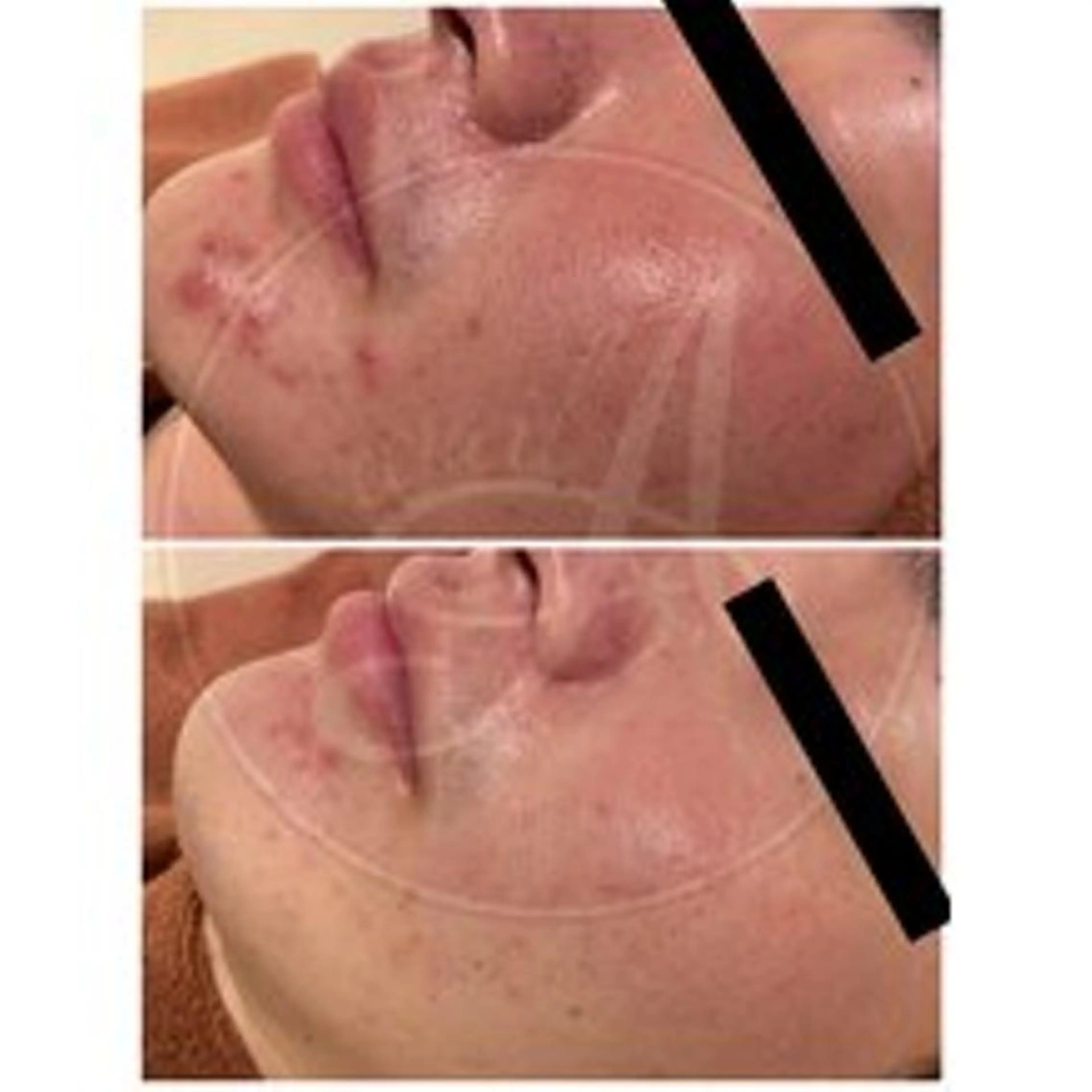 エステ リラク ニキビ特化型エステ 🍓最短で肌質改善のエステ・リラクイメージ