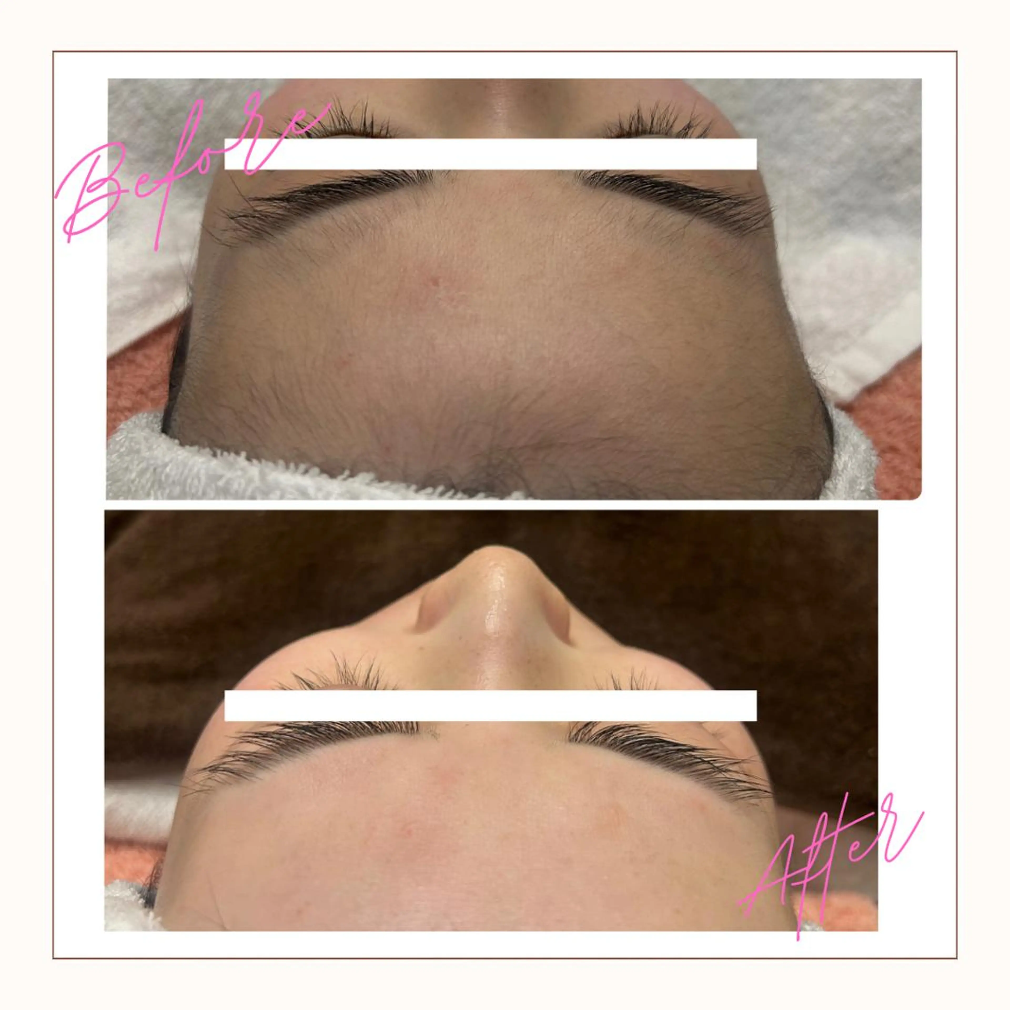 【1番人気✩】🐝⋆゜シュガーリング 顔シュガーリング脱毛の写真