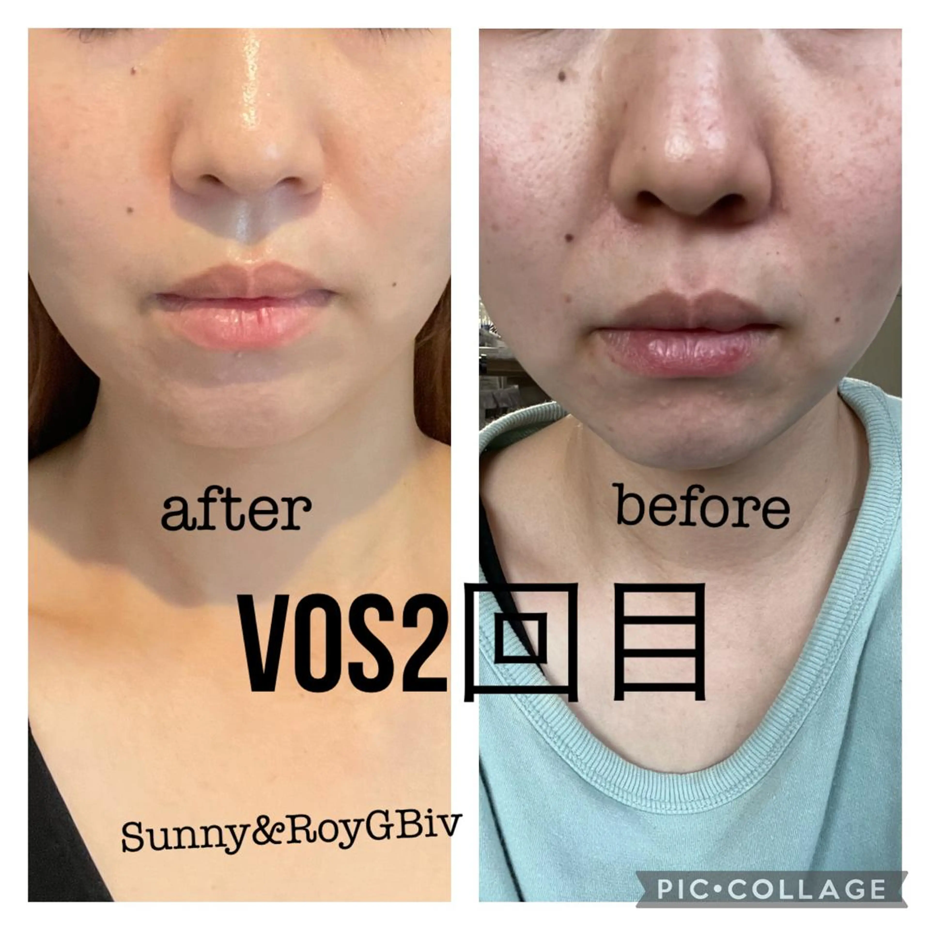 男女利用◎【VOSサロンケアエステ】ニキビ跡、ニキビ、毛穴に即効エステ！の写真