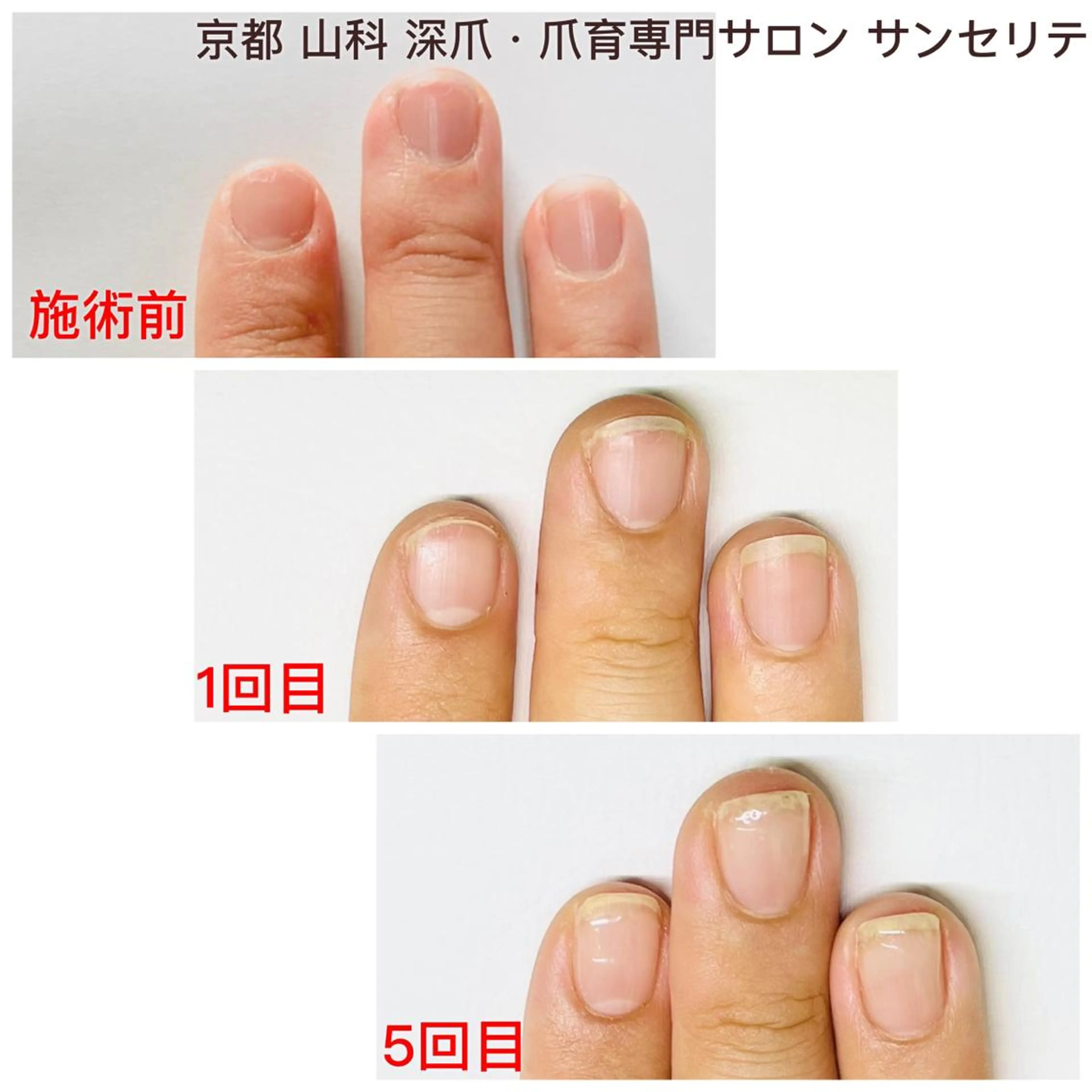 ハンドネイル ハンドケア 深爪・巻き爪 専門サンセリテのネイルデザイン