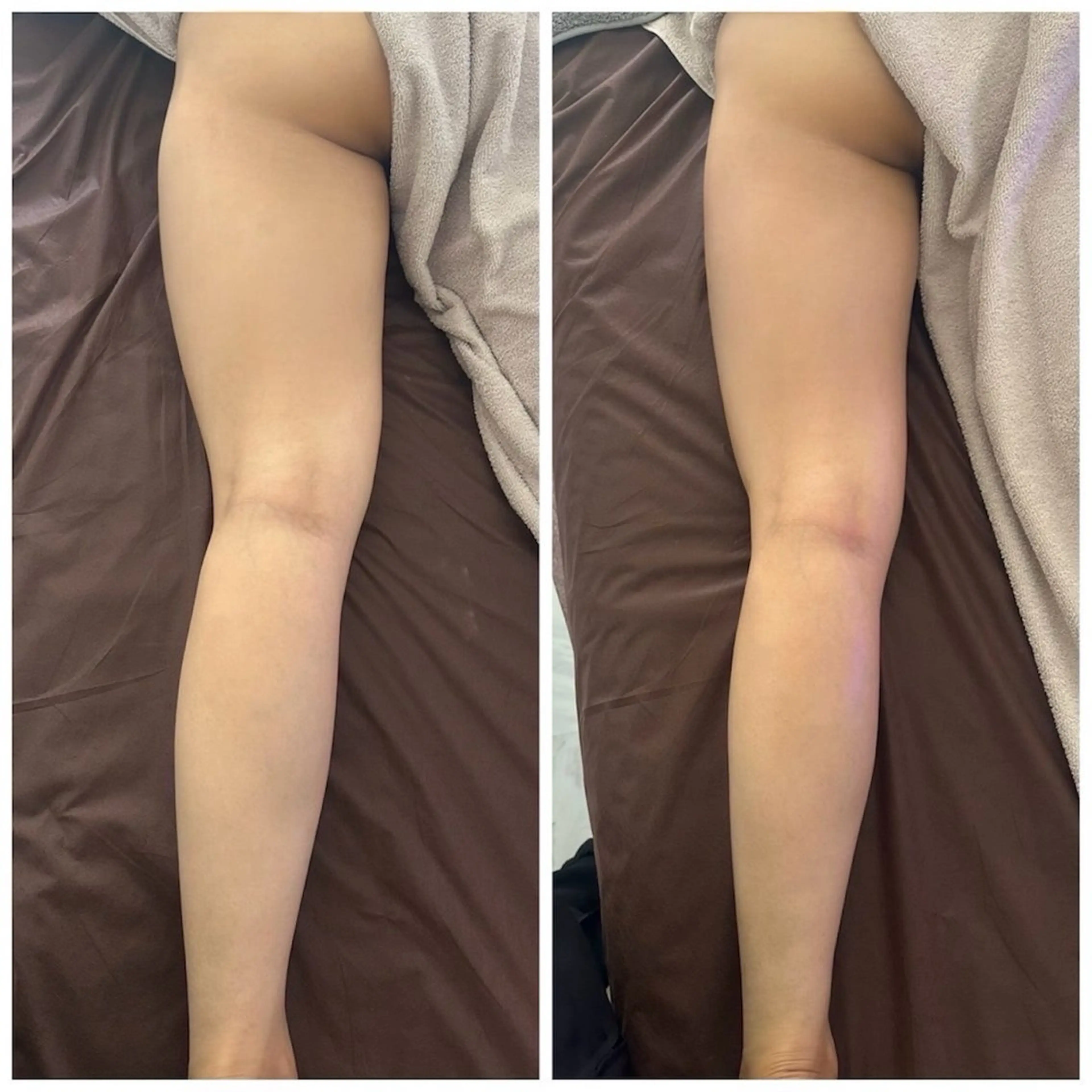 90分全身痩身サイズダウンコース(キャビテーション＋吸引 orハンド)の写真