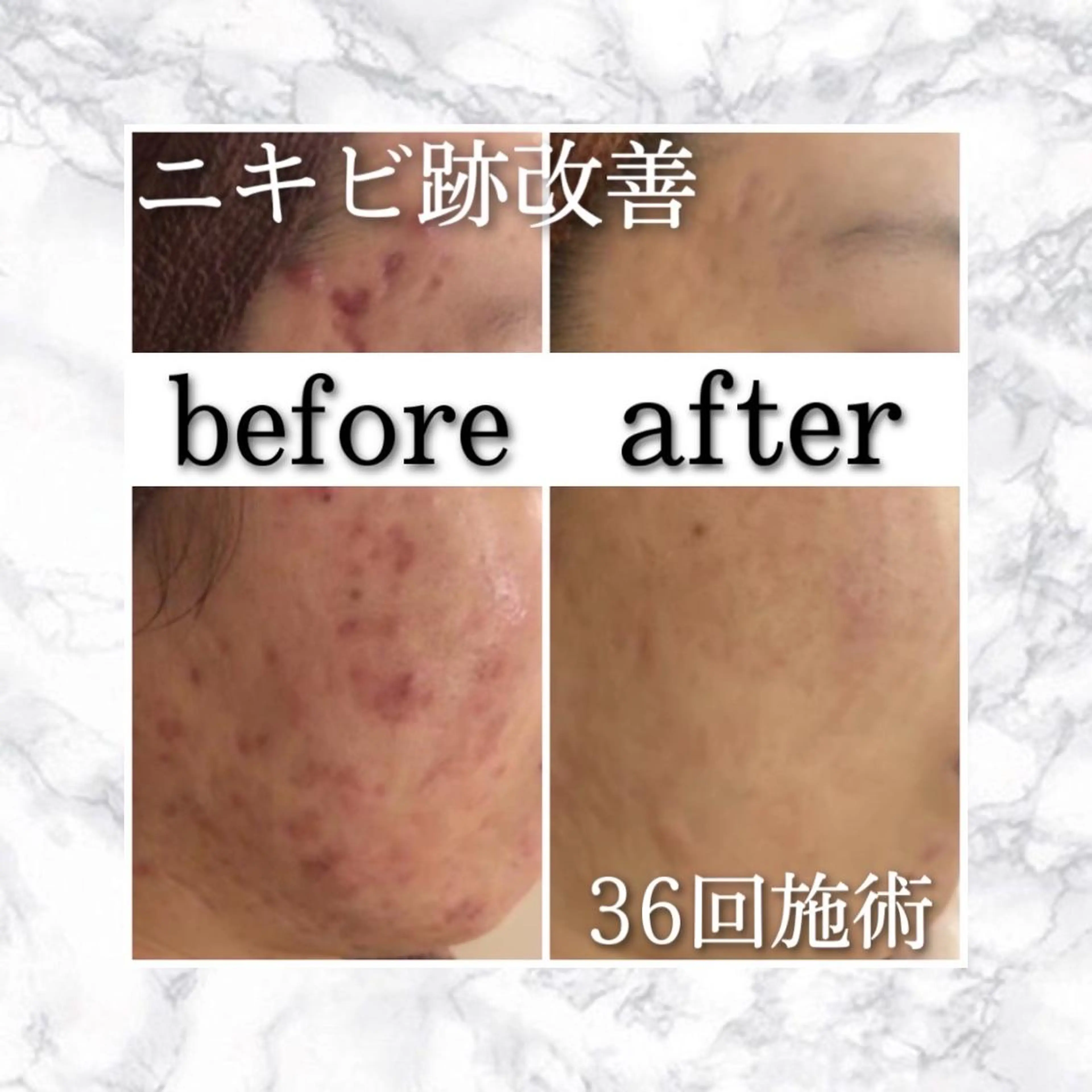 ロング カラー パーマ ヘアアレンジ メンズ キッズ ネイル マツエク・マツパ アイブロウ 夏までに肌荒れ卒業 するサロン🌻のエステ・リラクイメージ