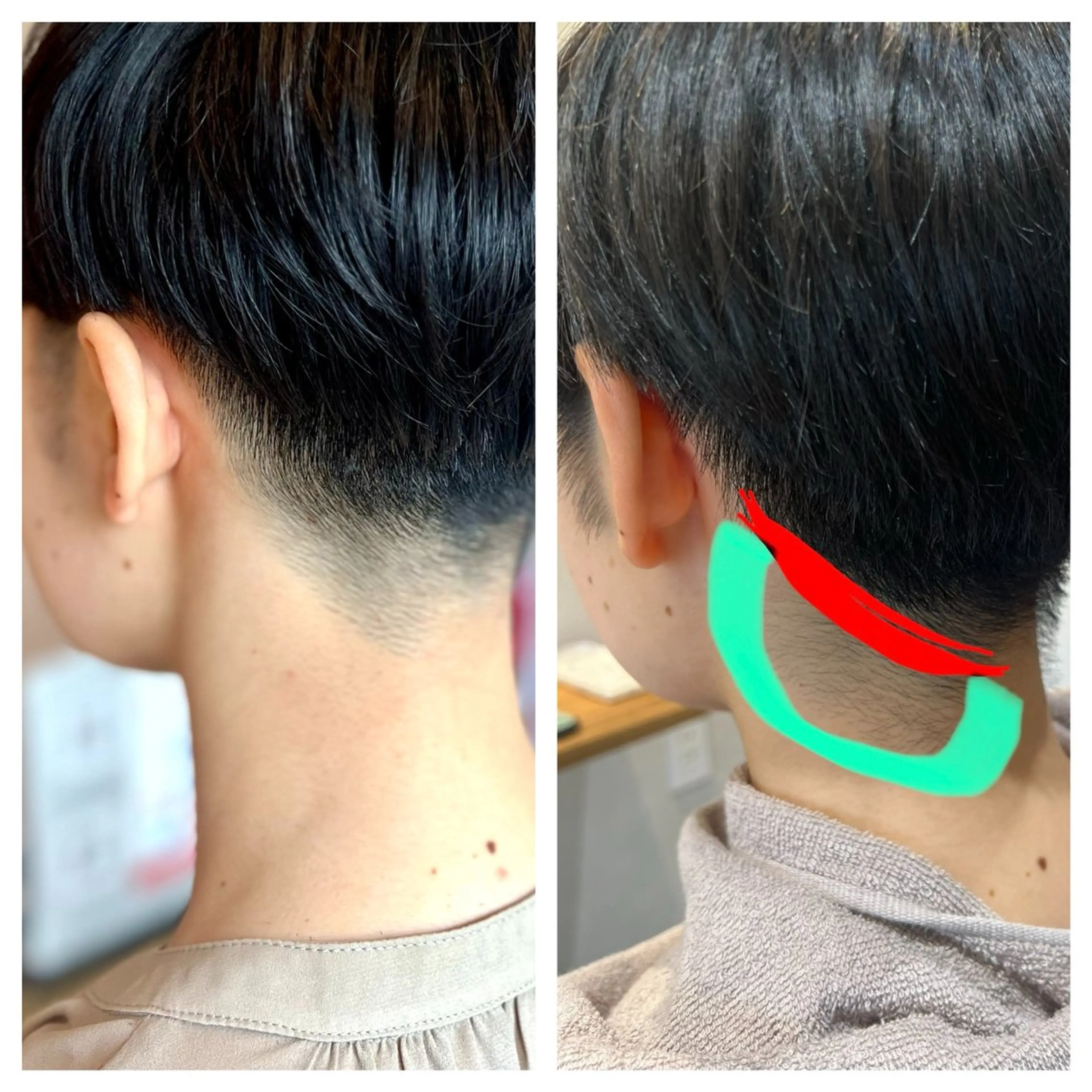 えりあし、うなじ脱毛の写真