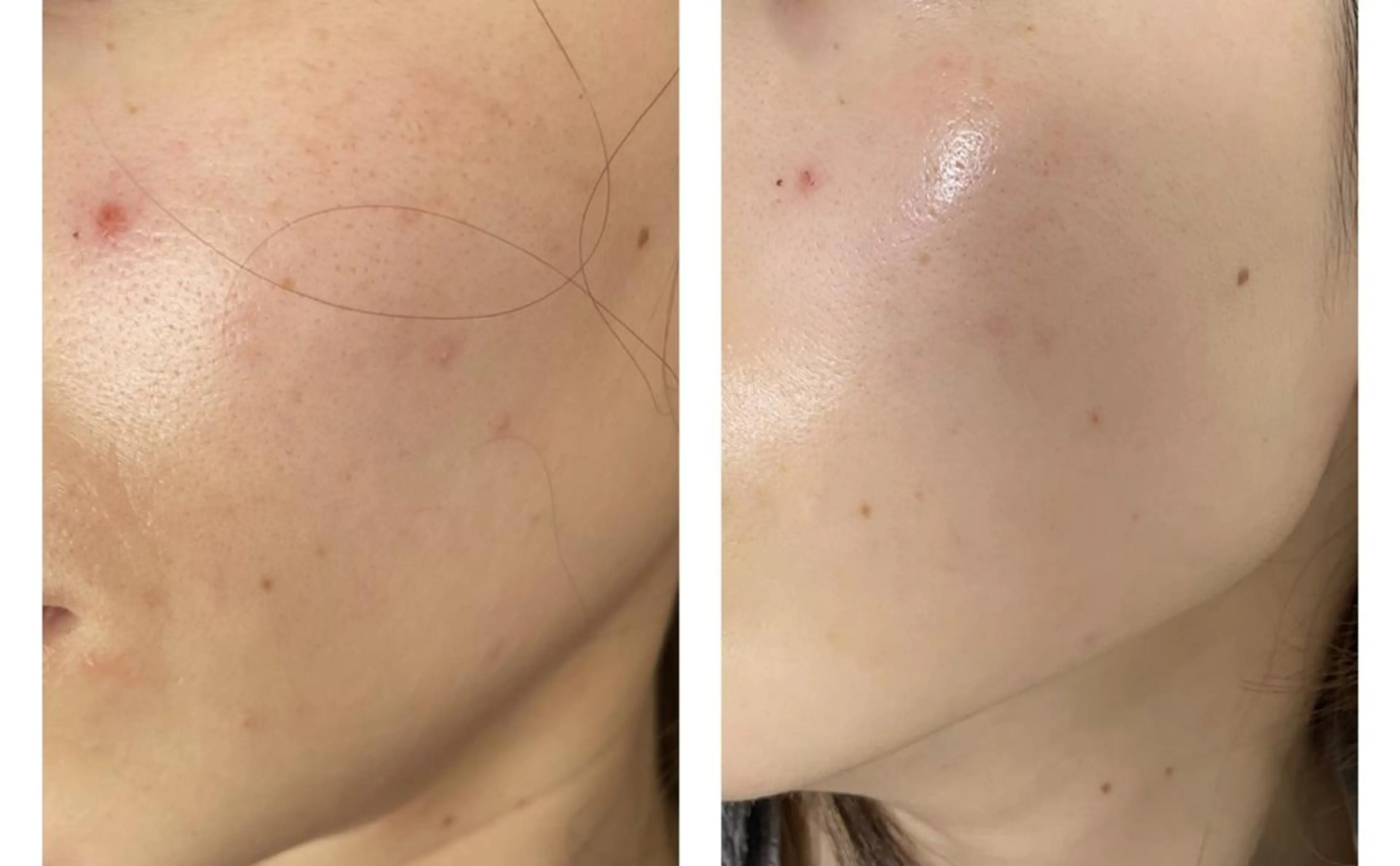 💖27日限定💖【毛穴撲滅コース】脱毛美肌へレイビス独自2段階シェービング付🌷エステ×脱毛だから導ける美肌を体感の写真