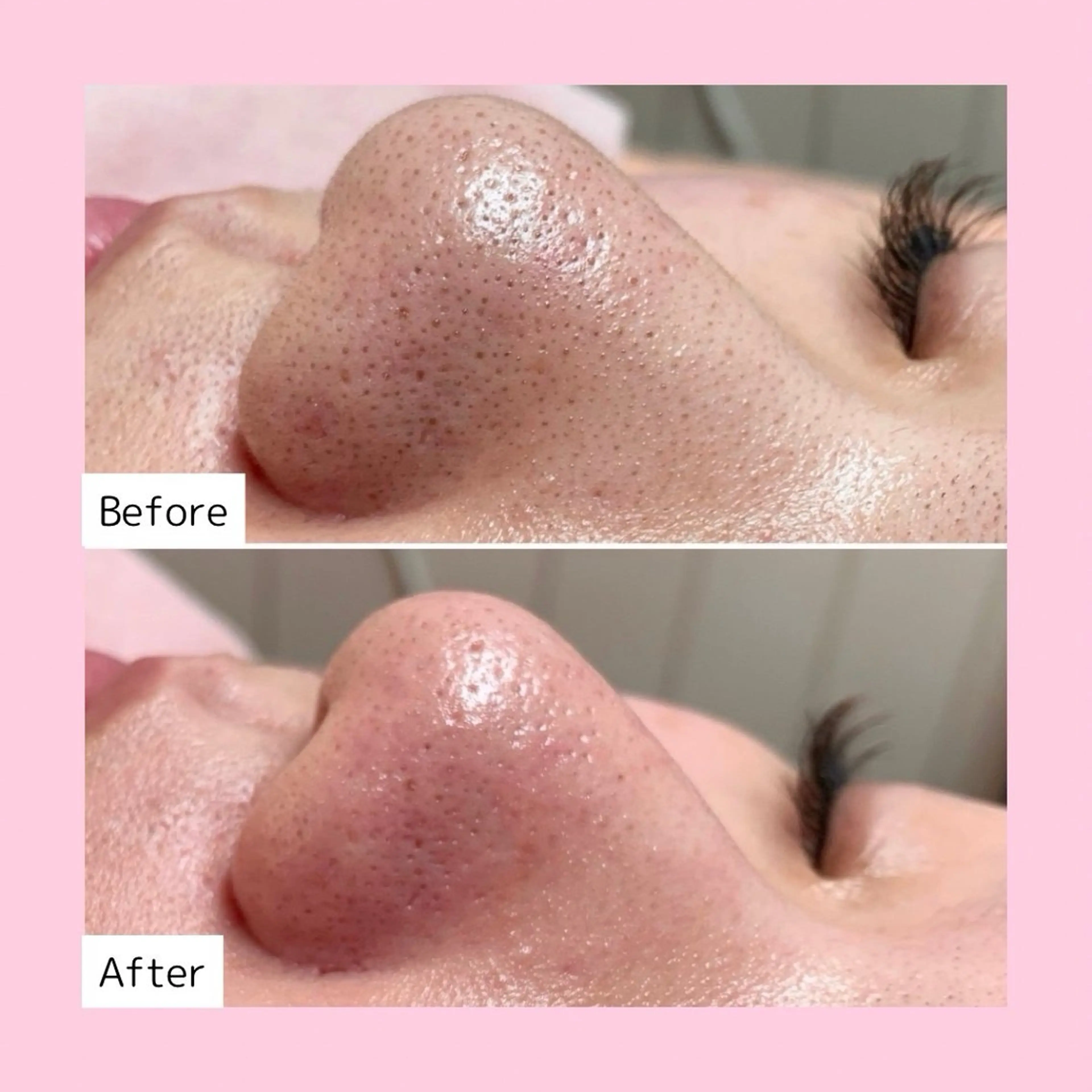 【韓国肌パック仕上げ/鎮静･消炎】毛穴洗浄 ハイドロフェイシャルの写真