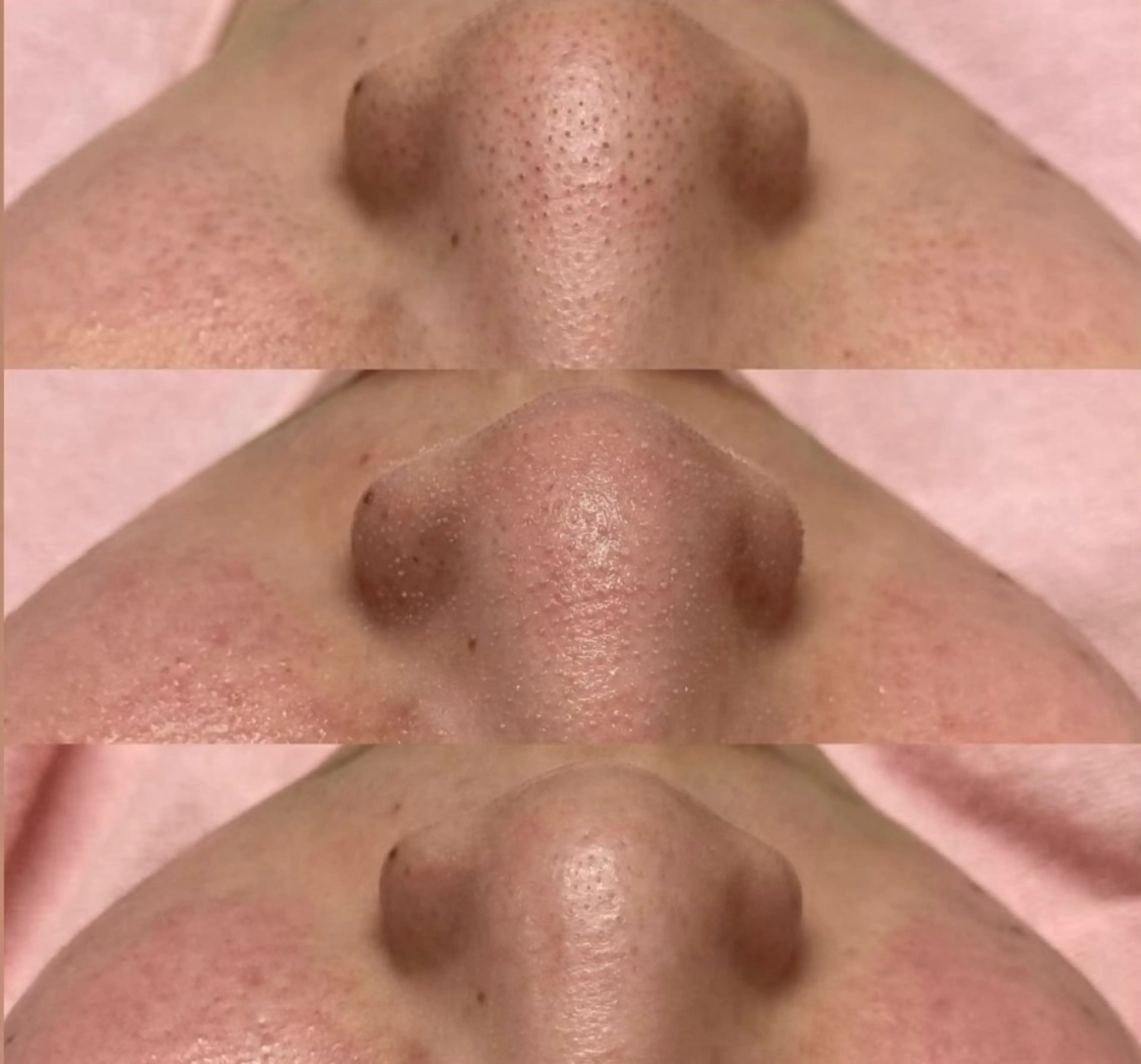 今話題の🔥毛穴エクストラクション🔥🫧最強毛穴撲滅メニュー‼️ブラックヘッドから毛穴の開きまで、毛穴の事ならお任せ!の写真