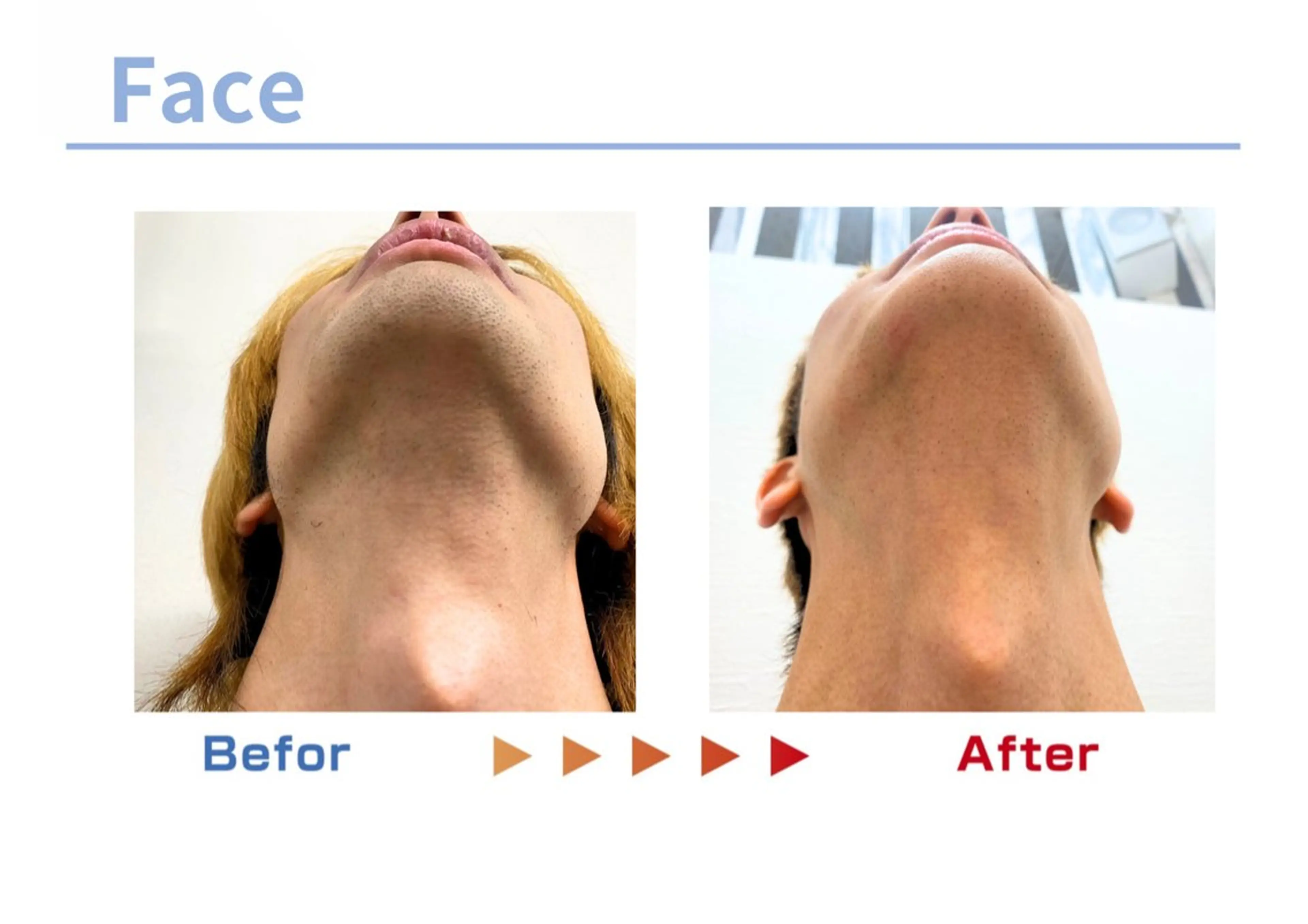 メンズ セルフ脱毛/美尻イス キングスサロン熊本のエステ・リラクイメージ