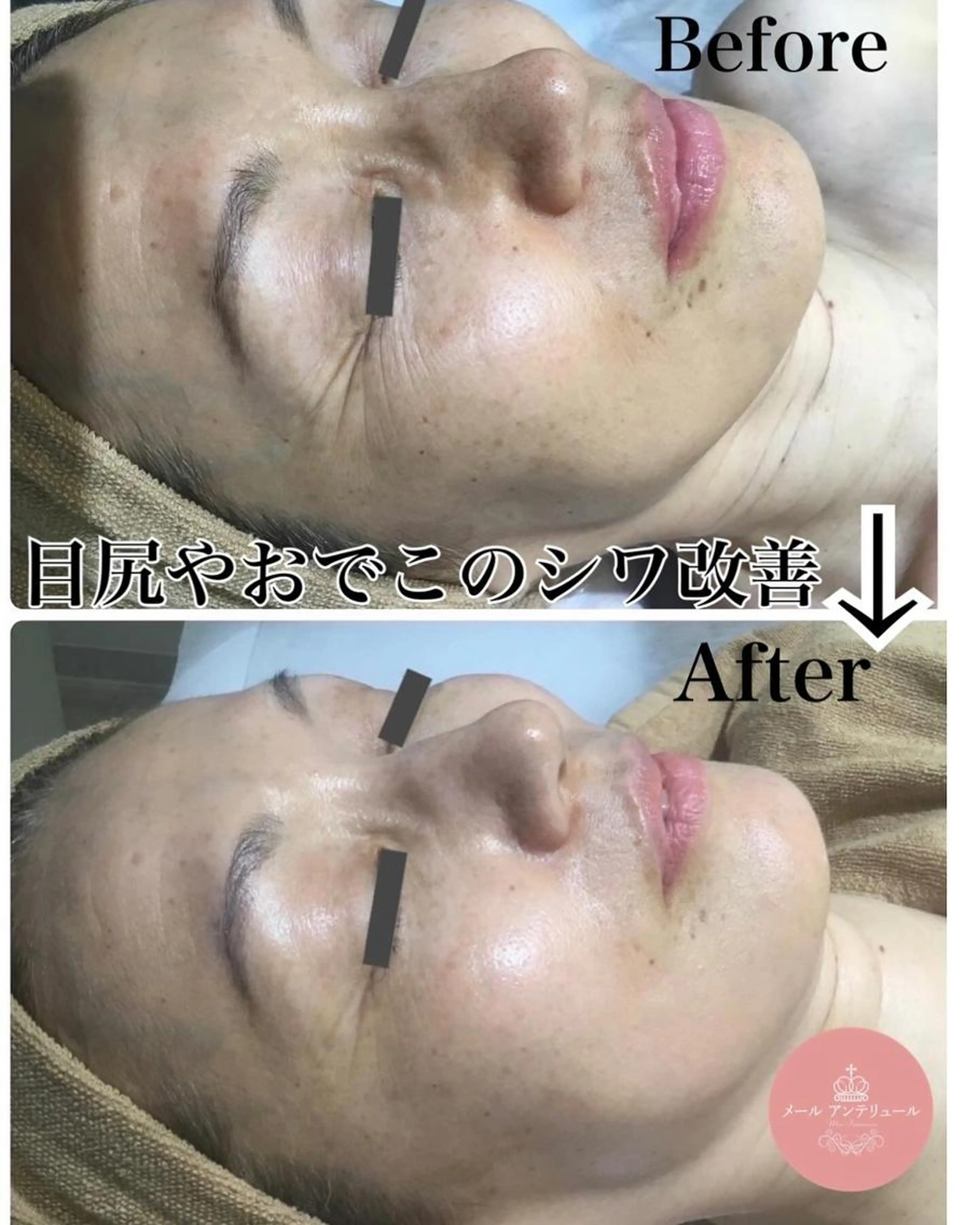 驚きの小顔とリフトアップ✨顔筋小顔 フェイシャル 💓[ 飯田橋 神楽坂 ］の写真