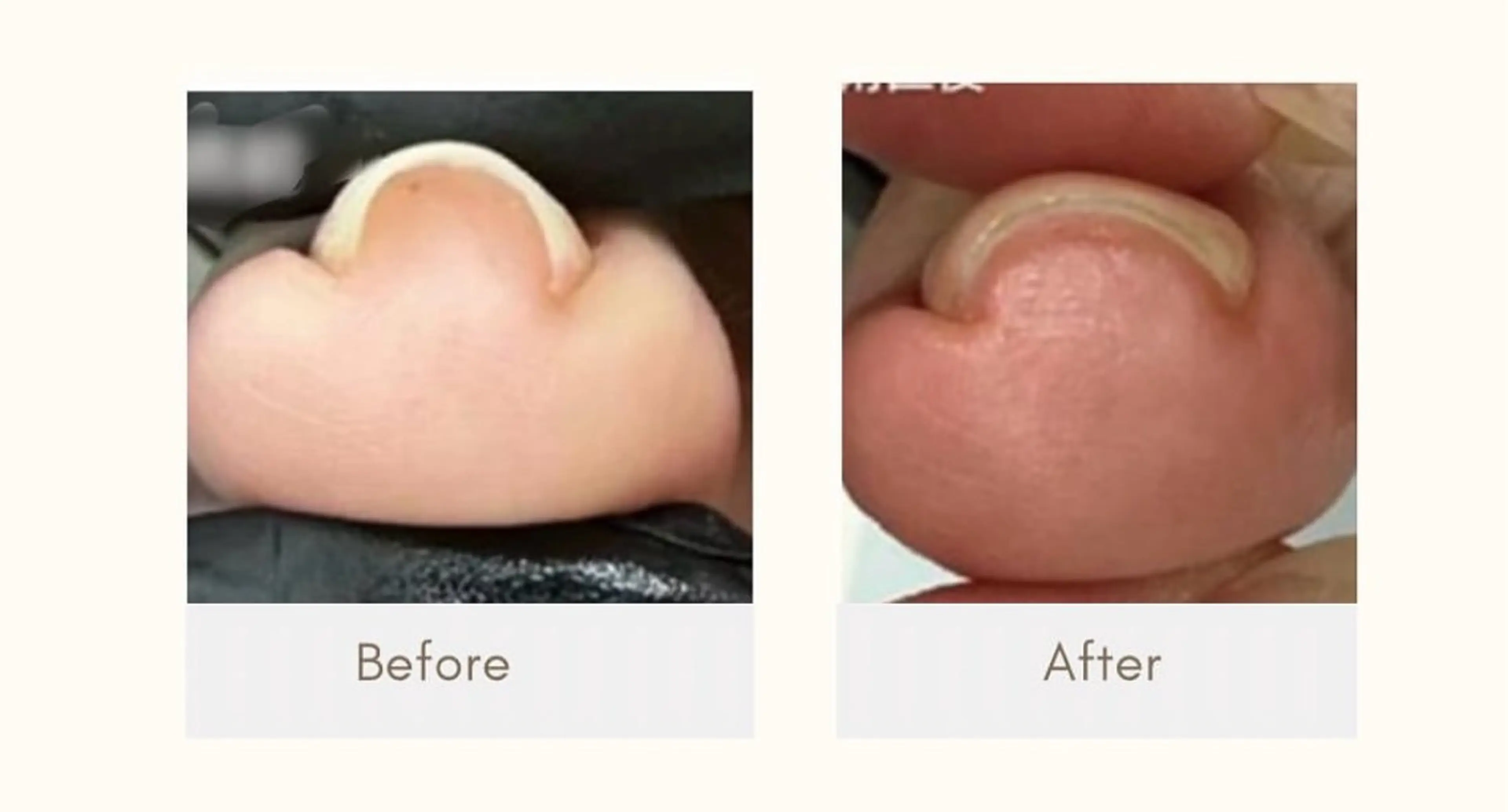 新メニュー✨　巻き爪改善ネイル【foot】の写真