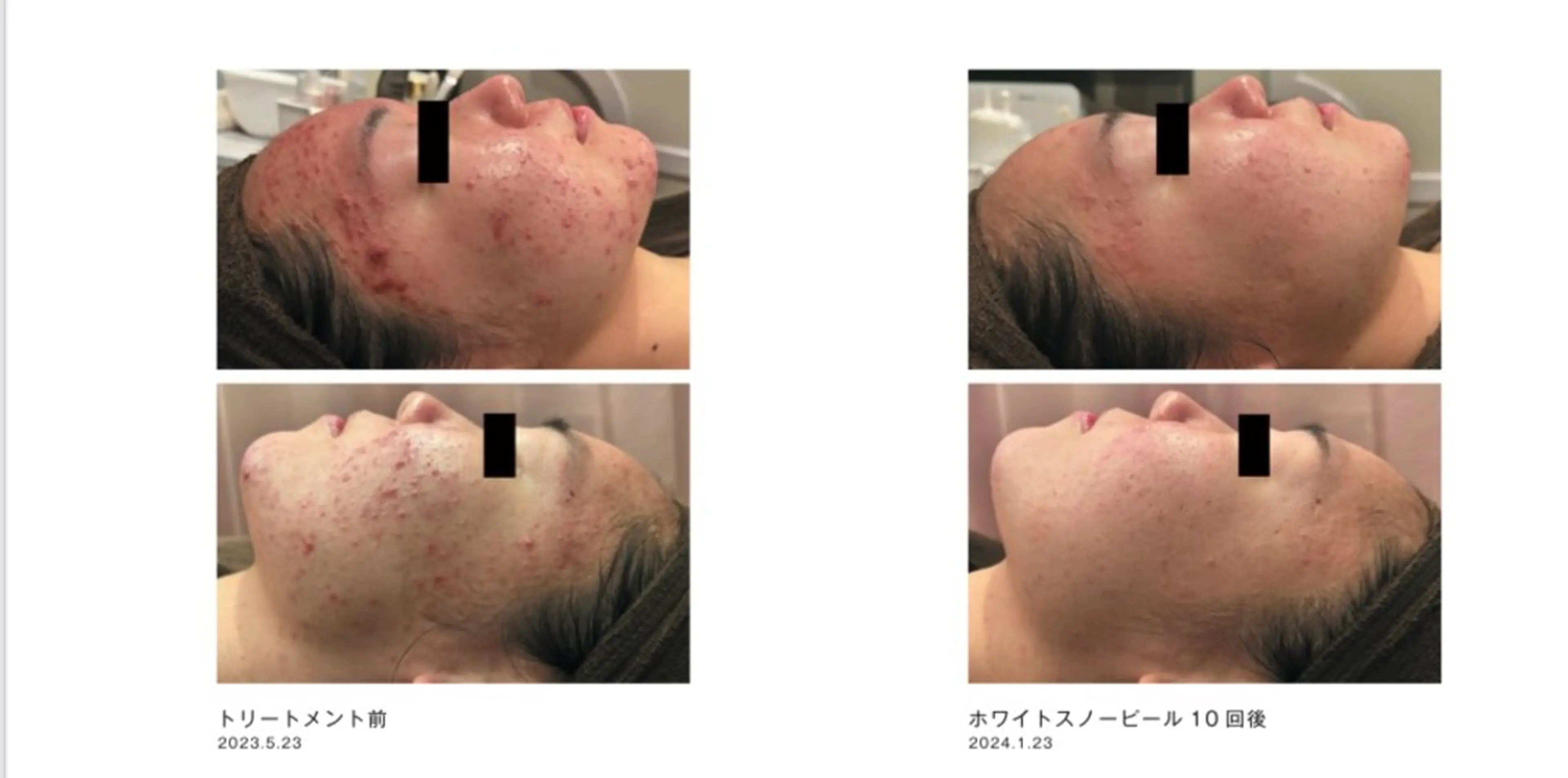 ピーリングケア 🤍moekoのエステ・リラクイメージ