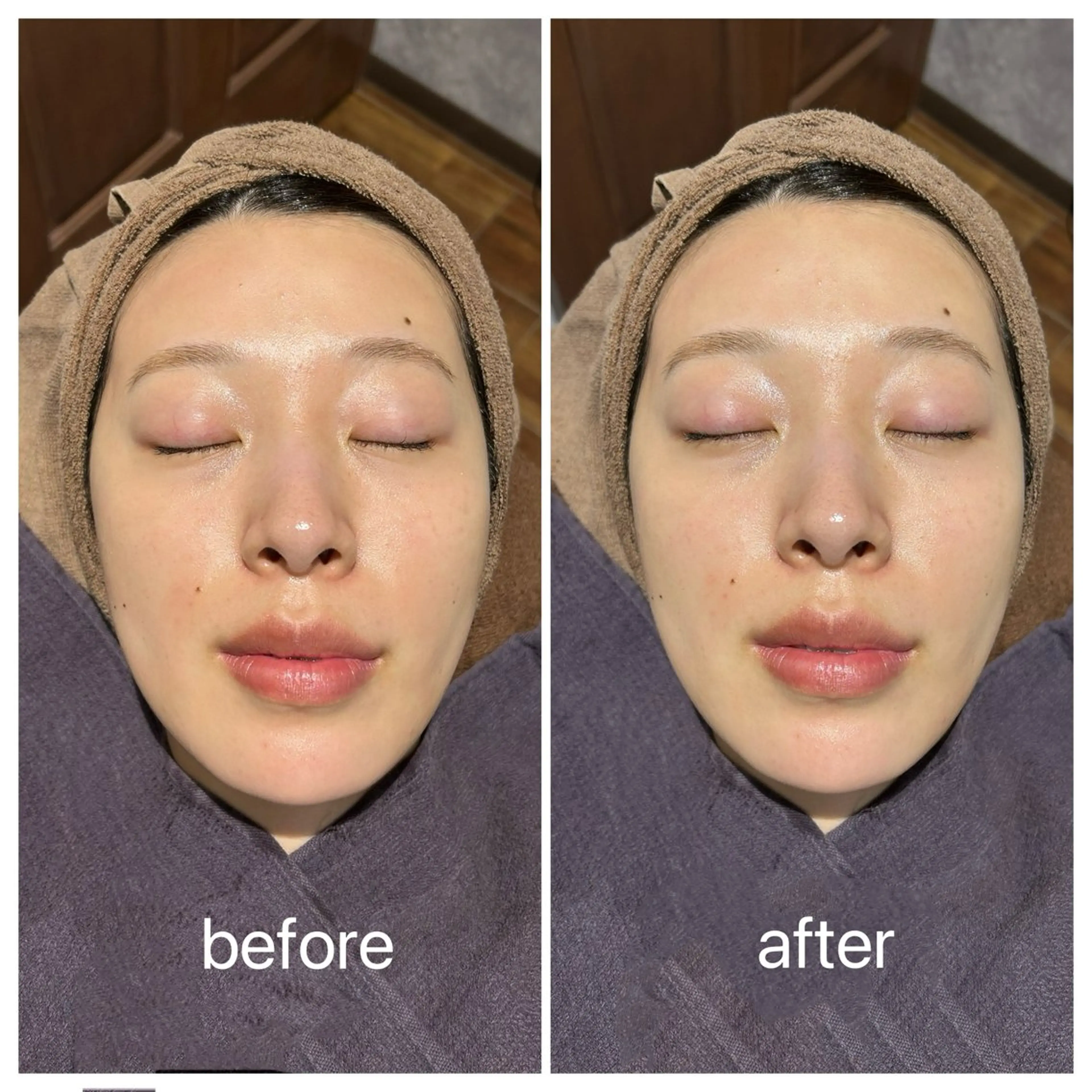 つや肌を手に入れる💎フェイシャルシェービング✨の写真