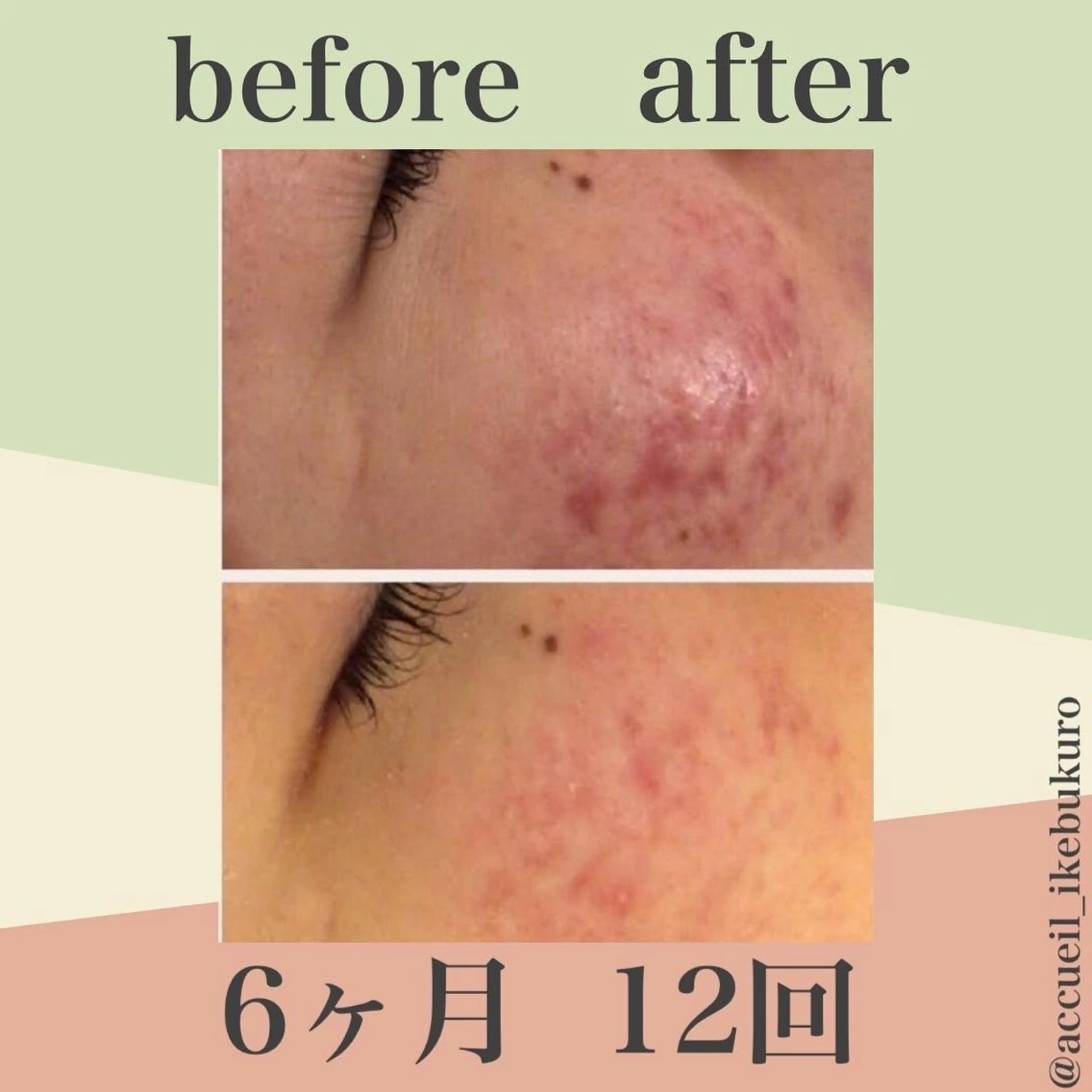 ミディアム カラー パーマ ヘアアレンジ メンズ キッズ ネイル マツエク・マツパ エステ リラク ニキビ・肌質改善専門 ♡人生が変わるサロンのエステ・リラクイメージ