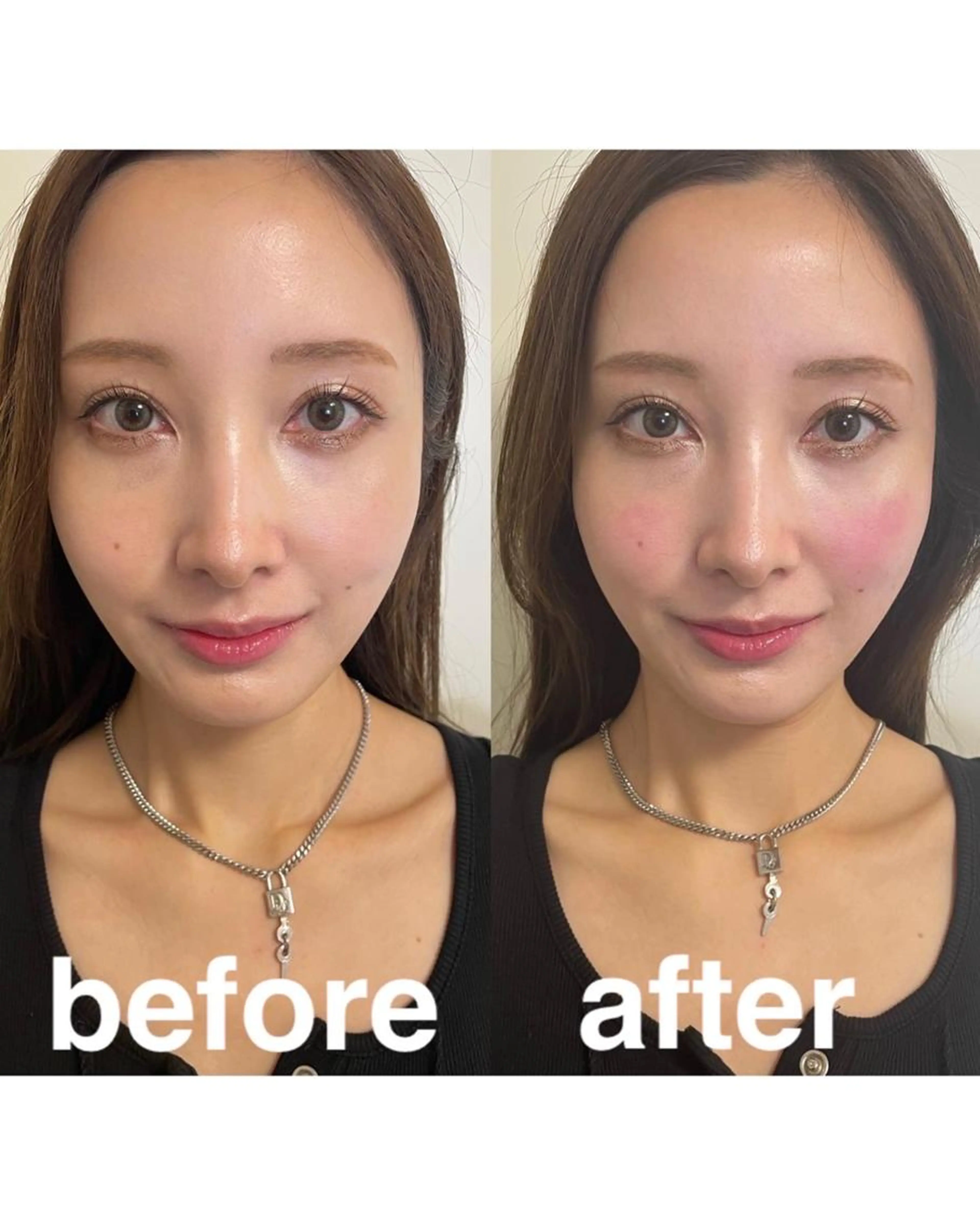 学割👩‍🎓🌸【小顔、むくみ改善】美容鍼/特別価格11800円→4990円　✨フェイスラインスッキリ✨の写真