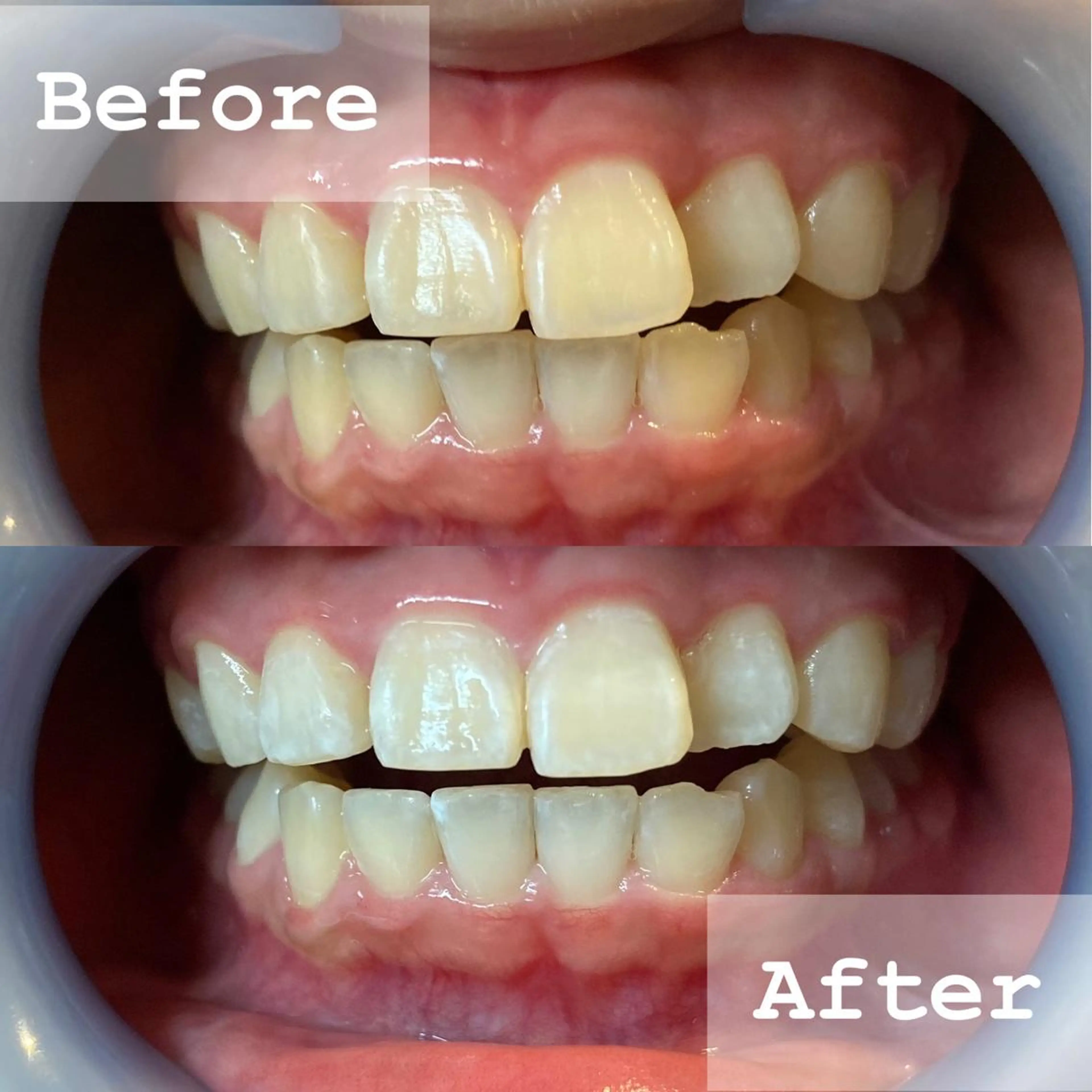 その他 LBSホワイトニング 新宿店💝公式のその他イメージ