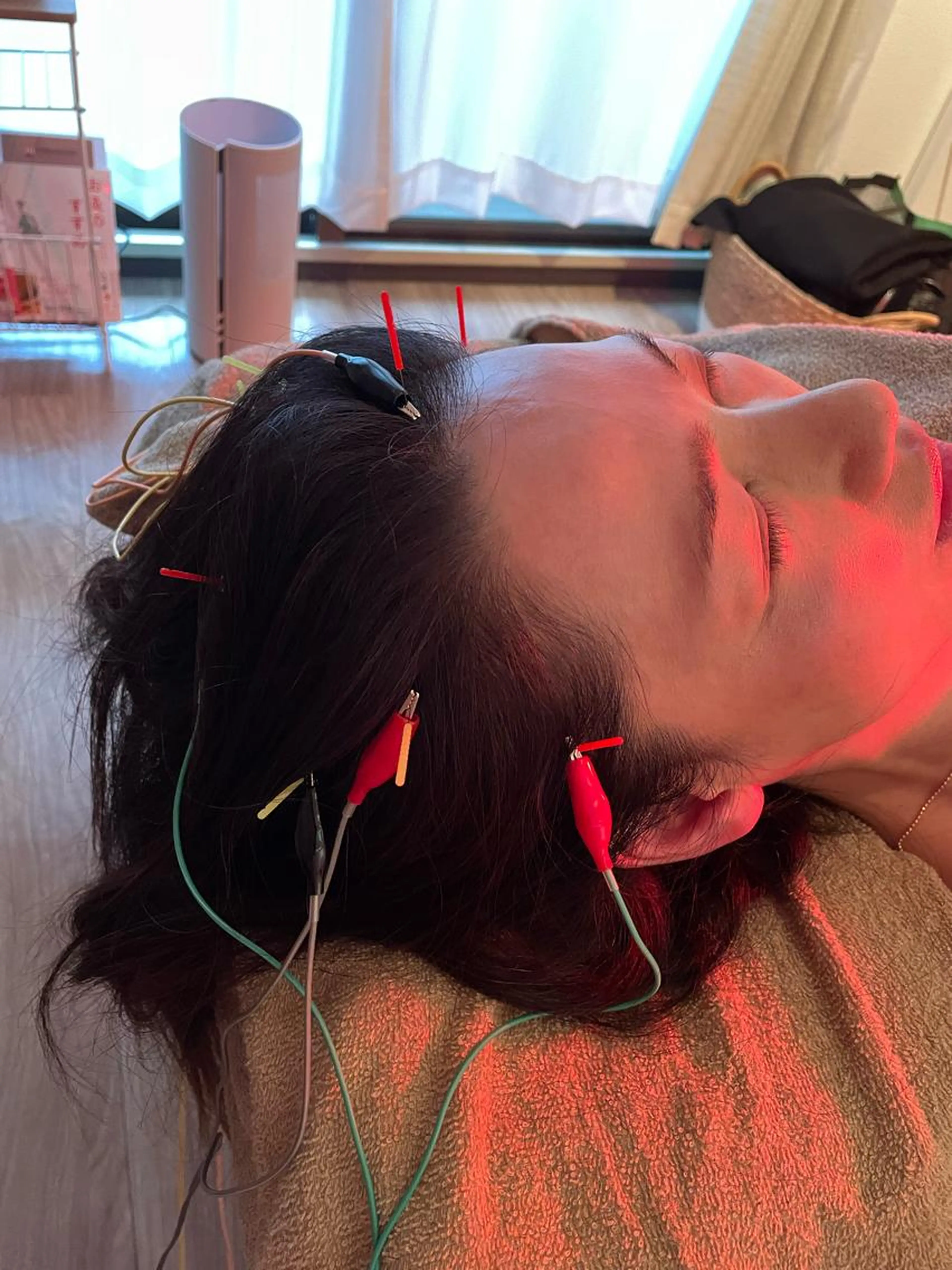 ドライヘッドスパ頭皮鍼(通電あり•なし)の写真