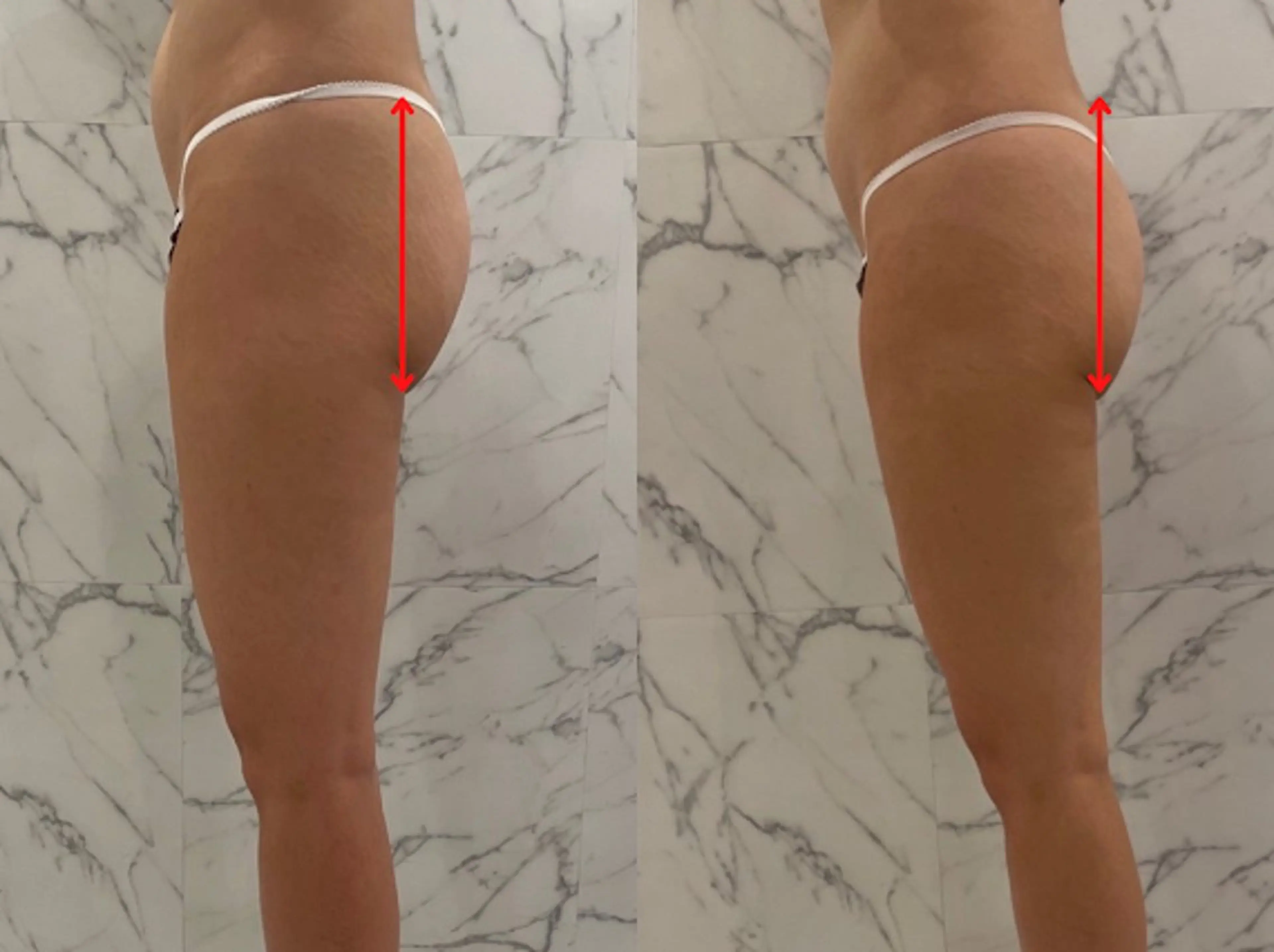 ケアボディ【隠れ人気メニュー◎】目指せ美尻♪世界特殊波形MRFでヒップアップ！60分+よもぎ蒸し30分￥6000の写真